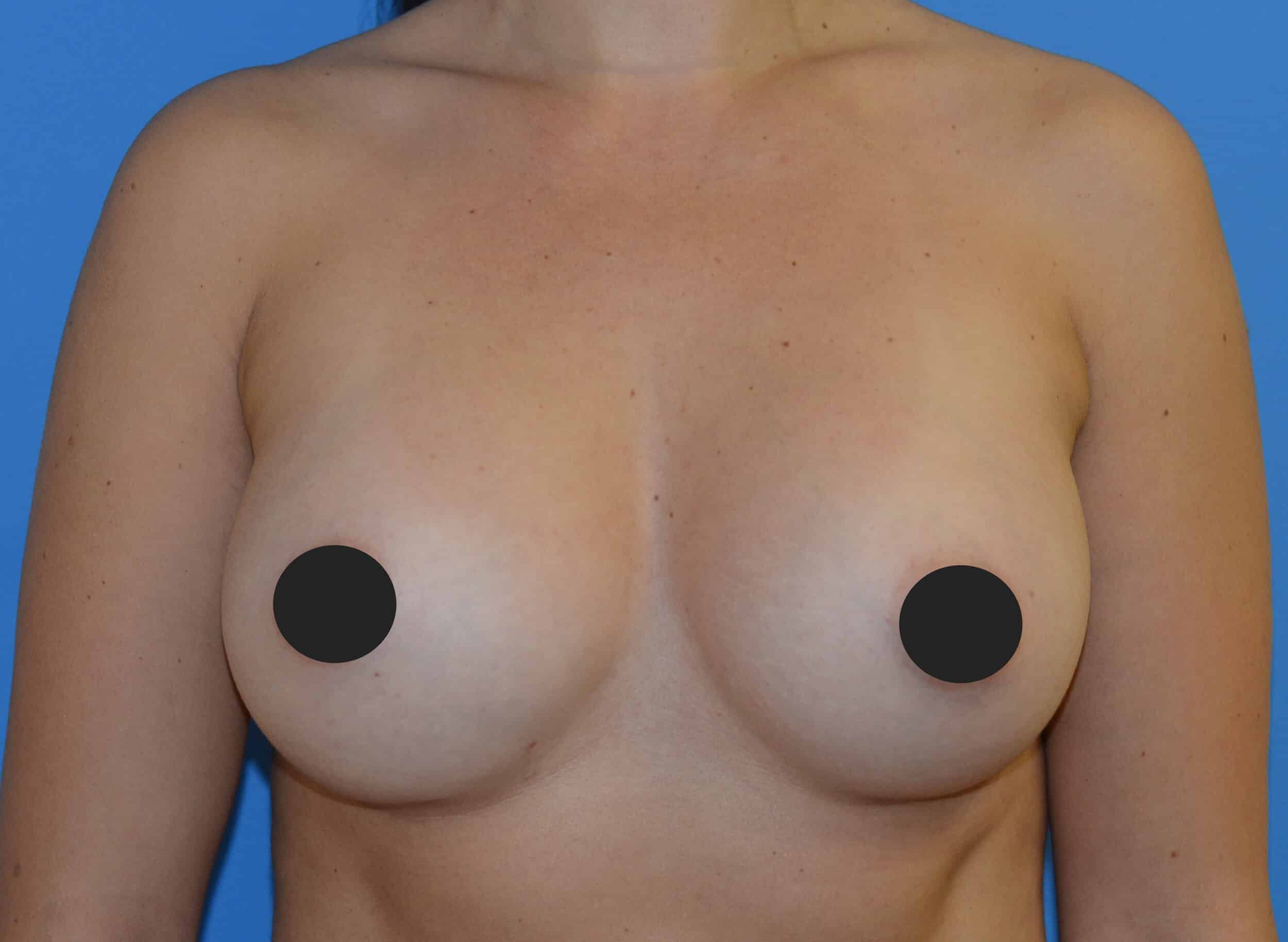 After Image: Breast Augmentation - front