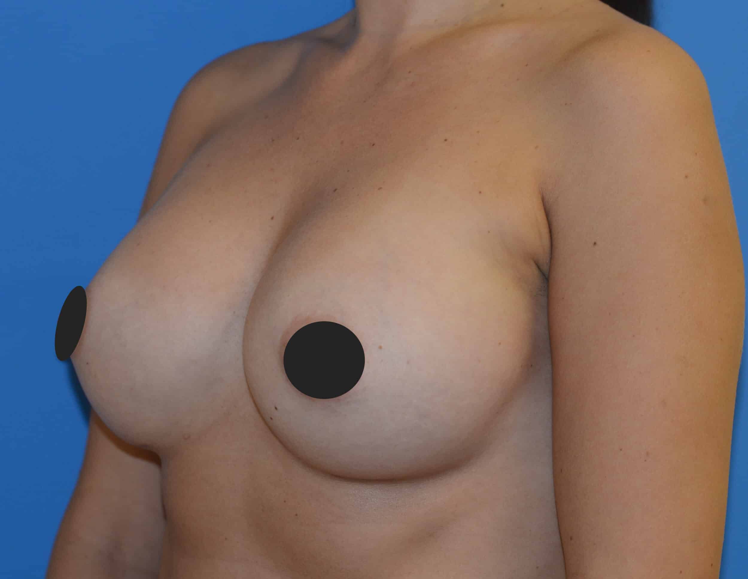 After Image: Breast Augmentation - left-front-oblique