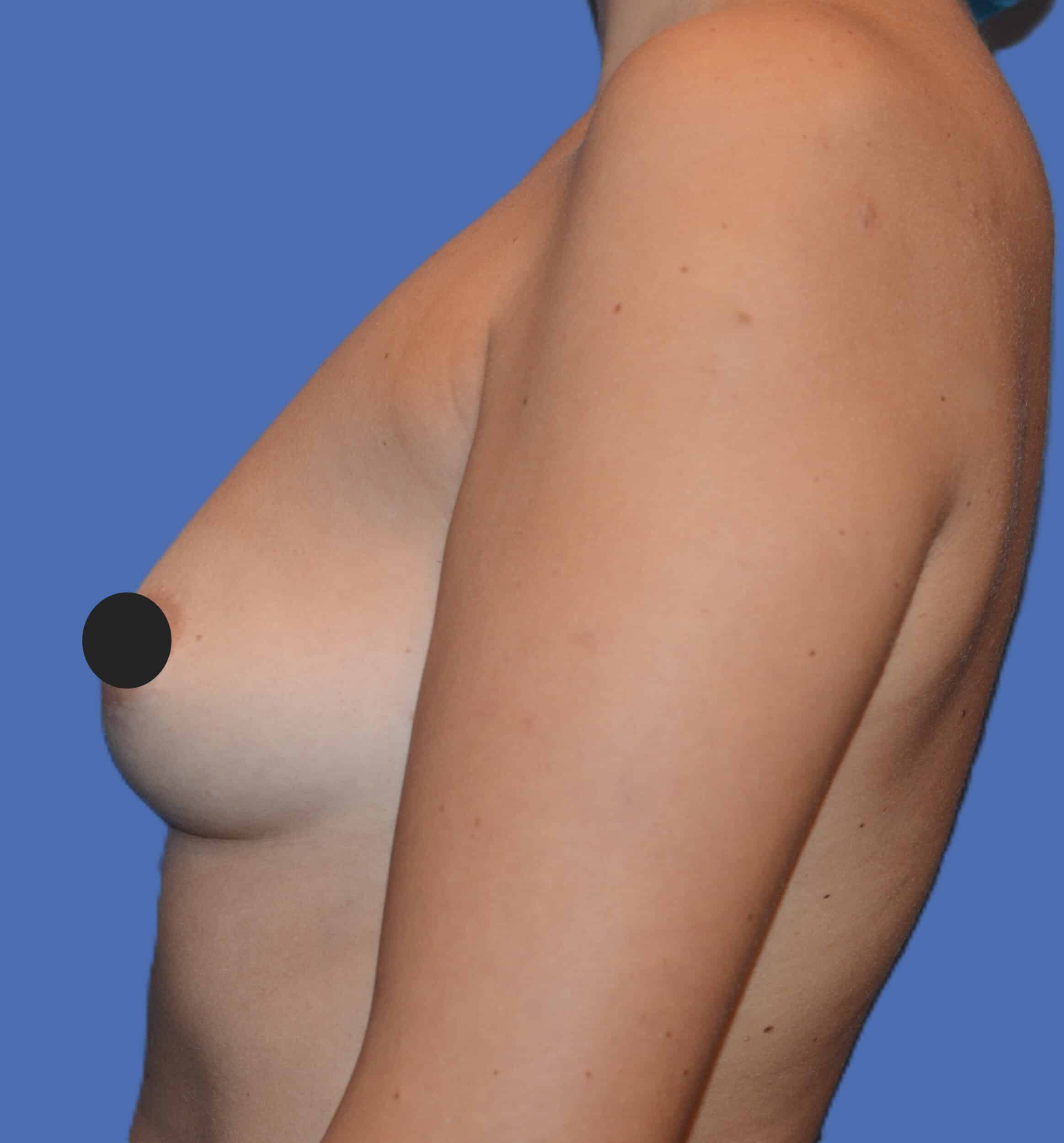 Before Image: Breast Augmentation - left-side