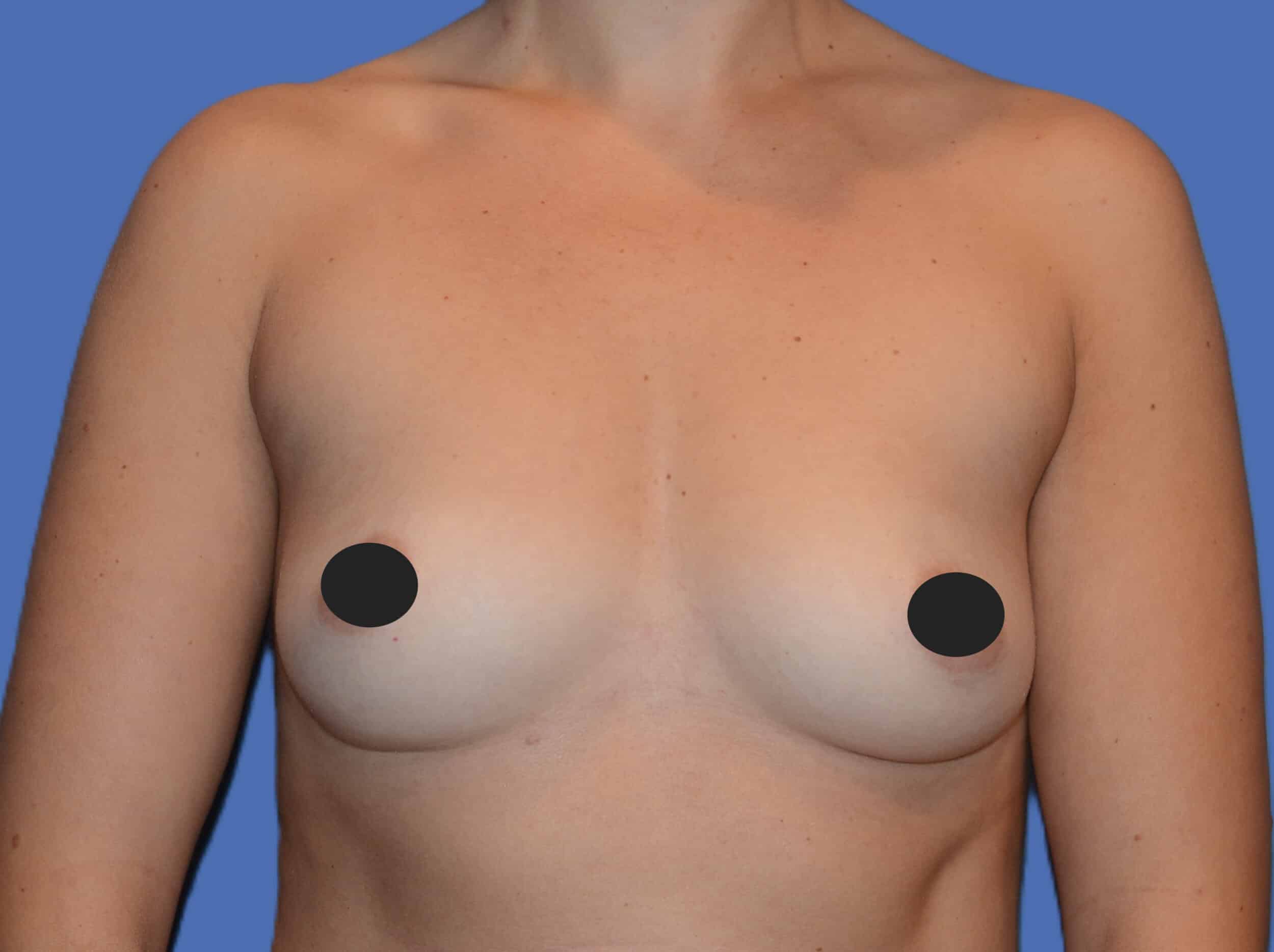 Before Image: Breast Augmentation - front