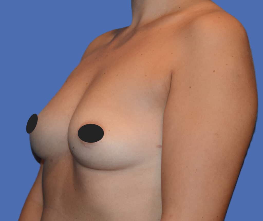Before Image: Breast Augmentation - left-front-oblique