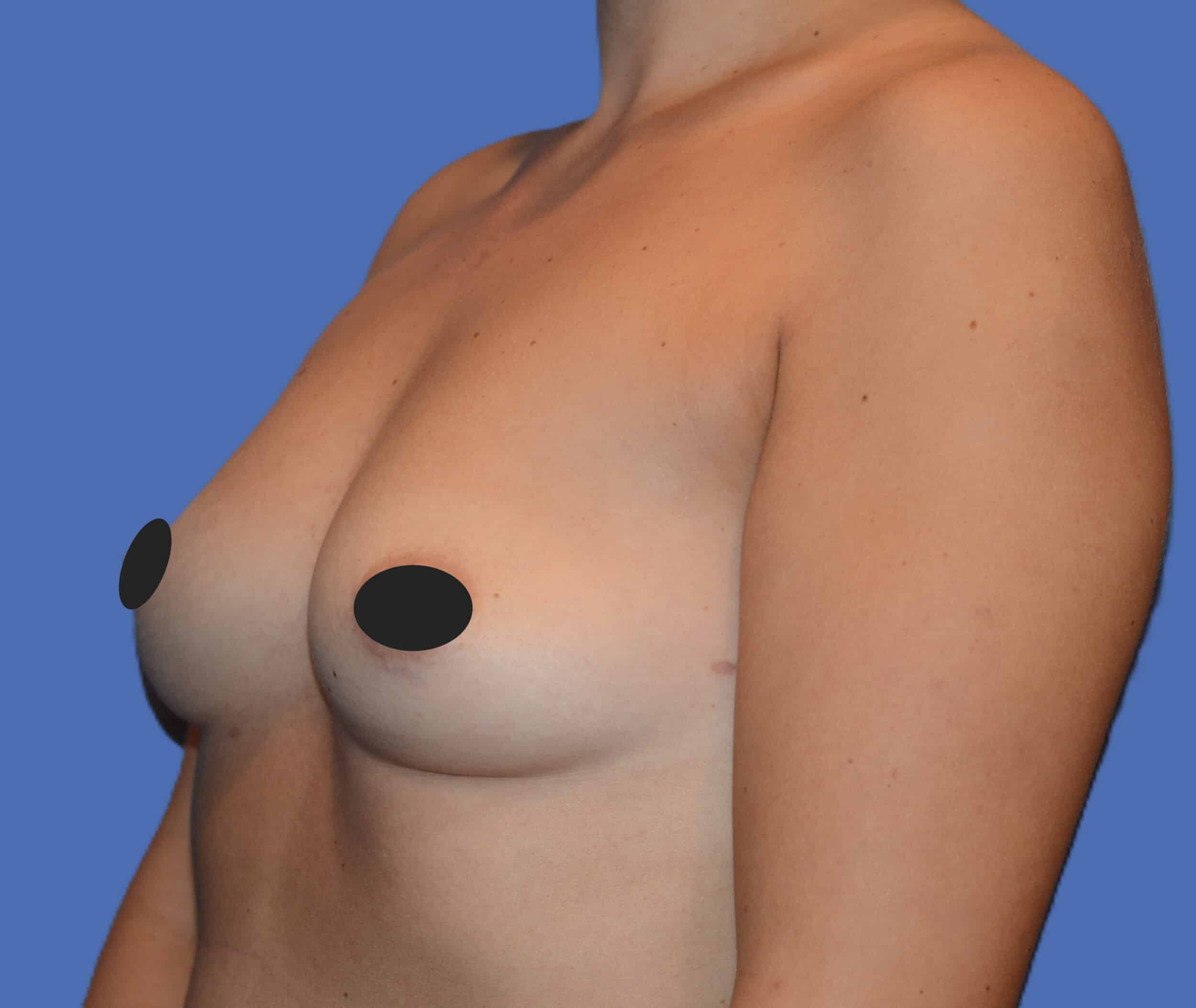 Before Image: Breast Augmentation - left-front-oblique