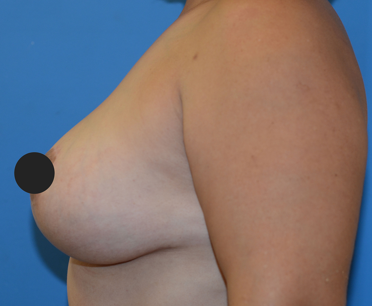 After Image: Breast Augmentation and Lift - left-side