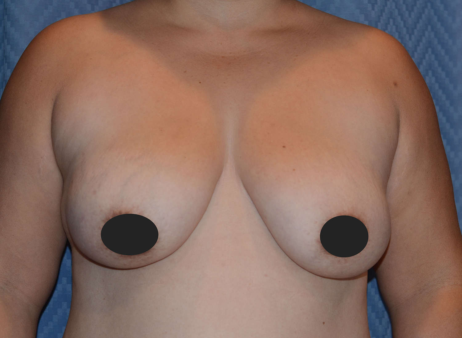 Before Image: Breast Augmentation and Lift - front