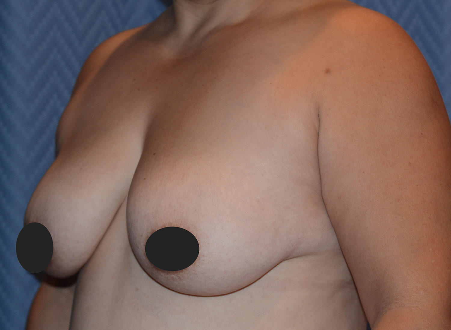 Before Image: Breast Augmentation and Lift - left-front-oblique