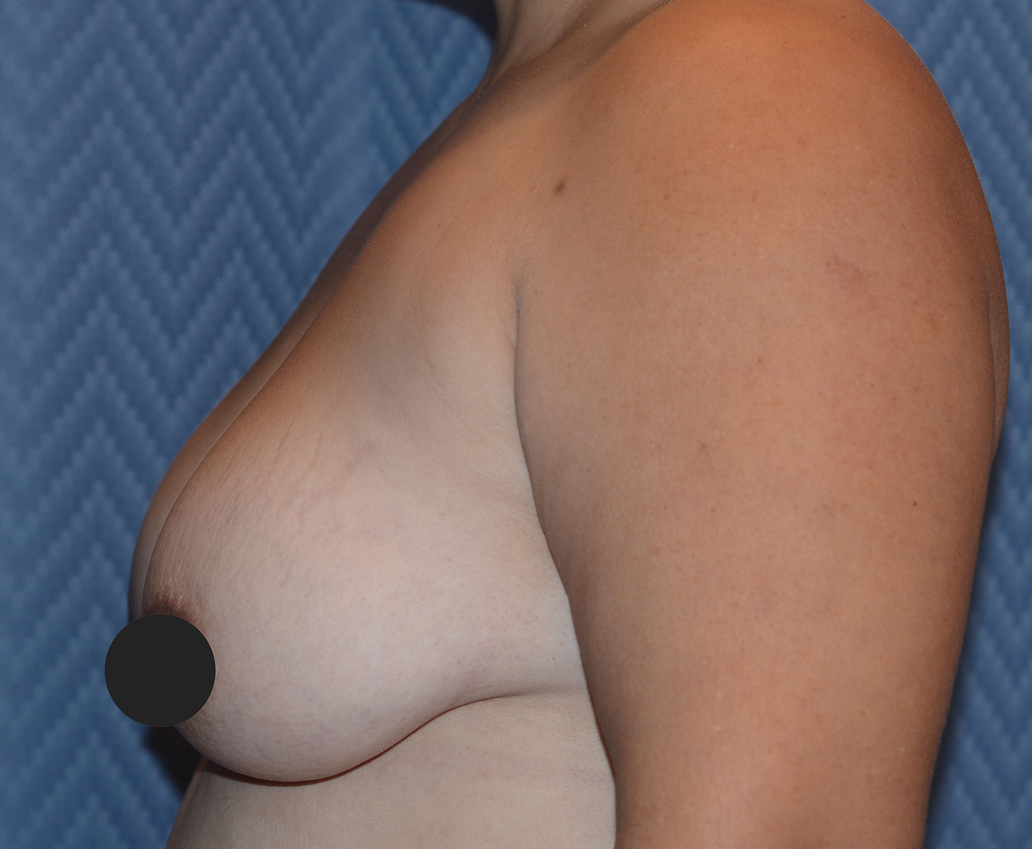 Before Image: Breast Augmentation and Lift - left-side