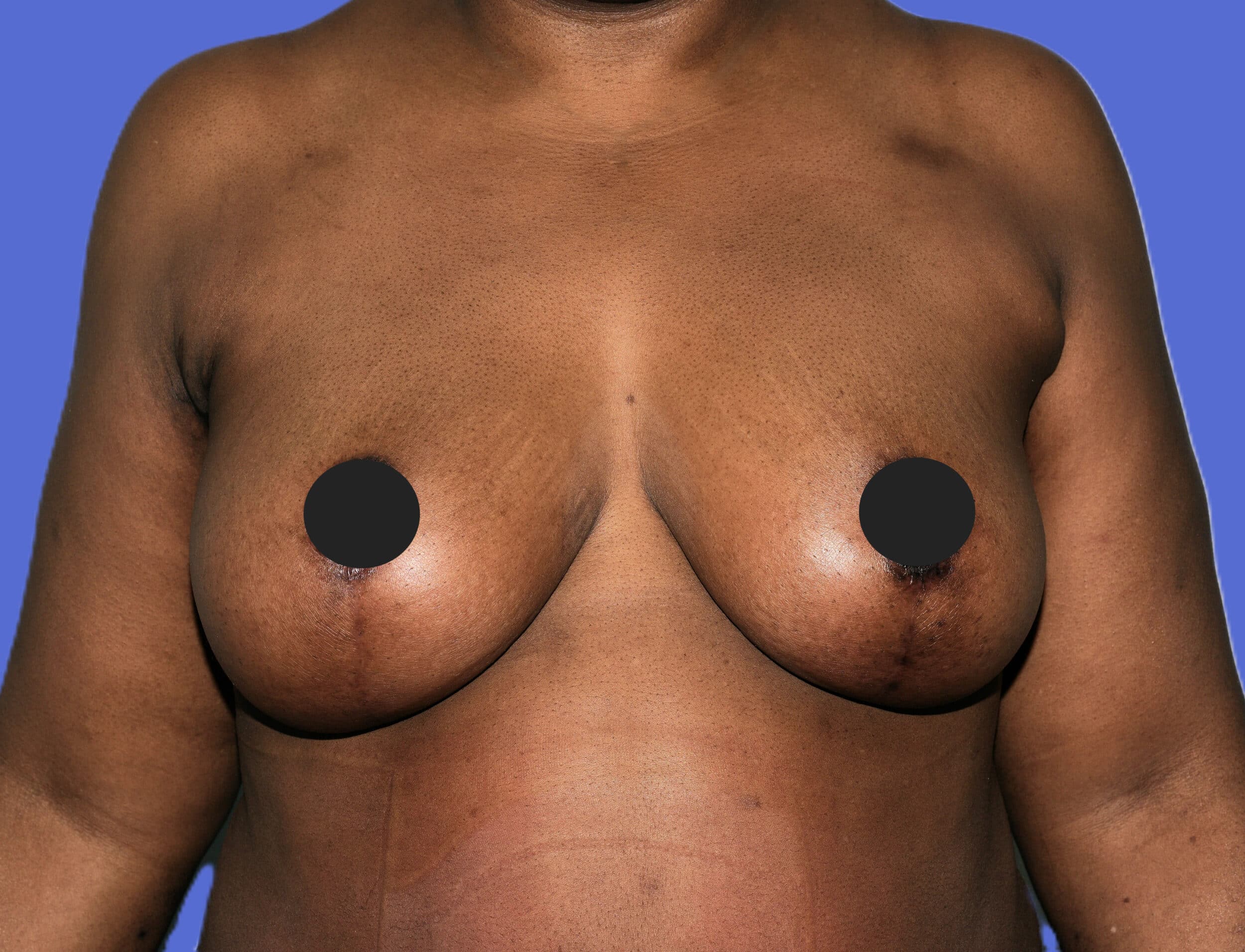 After Image: Breast Lift and Augmentation - front