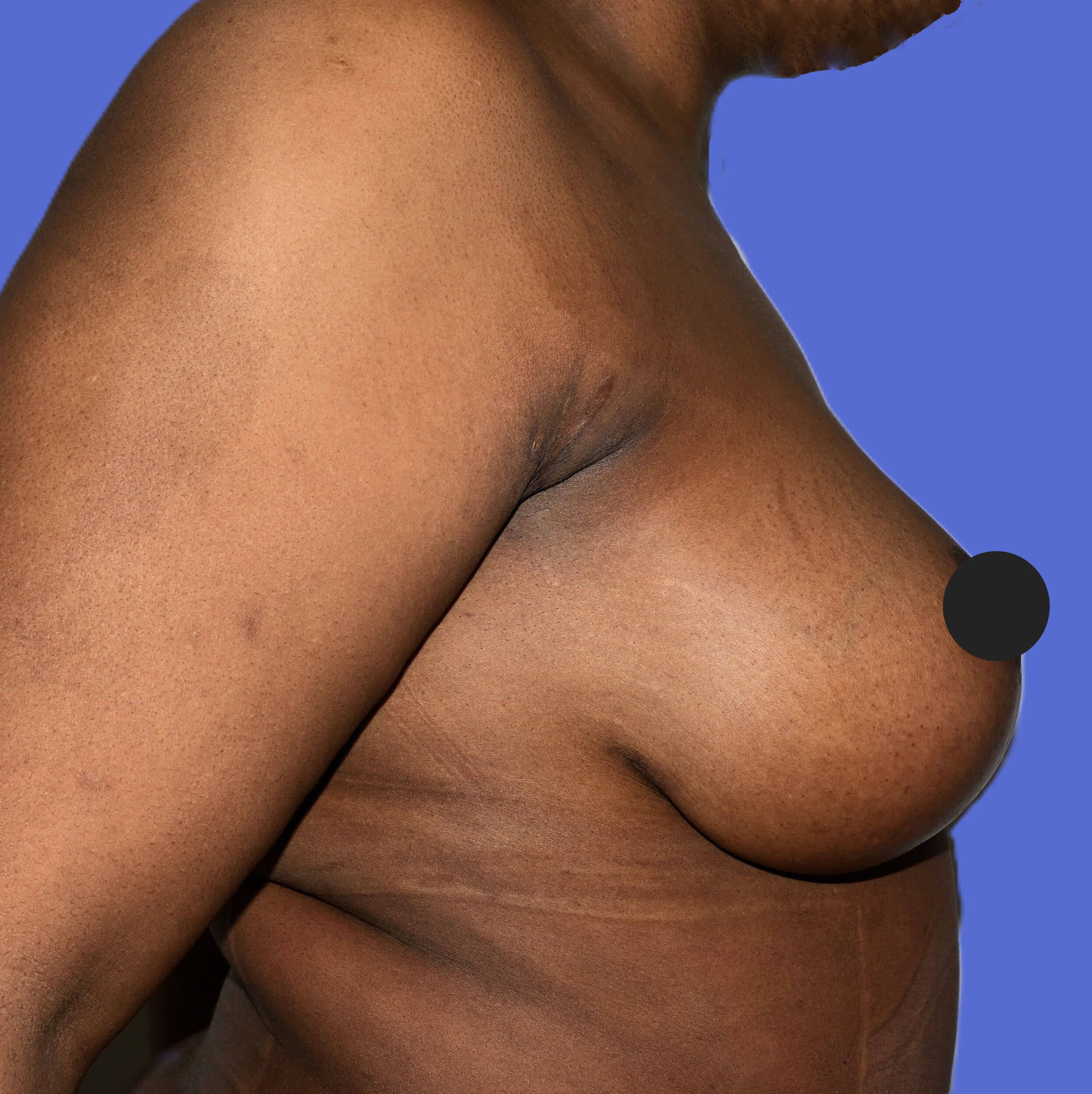 After Image: Breast Lift and Augmentation - right-side