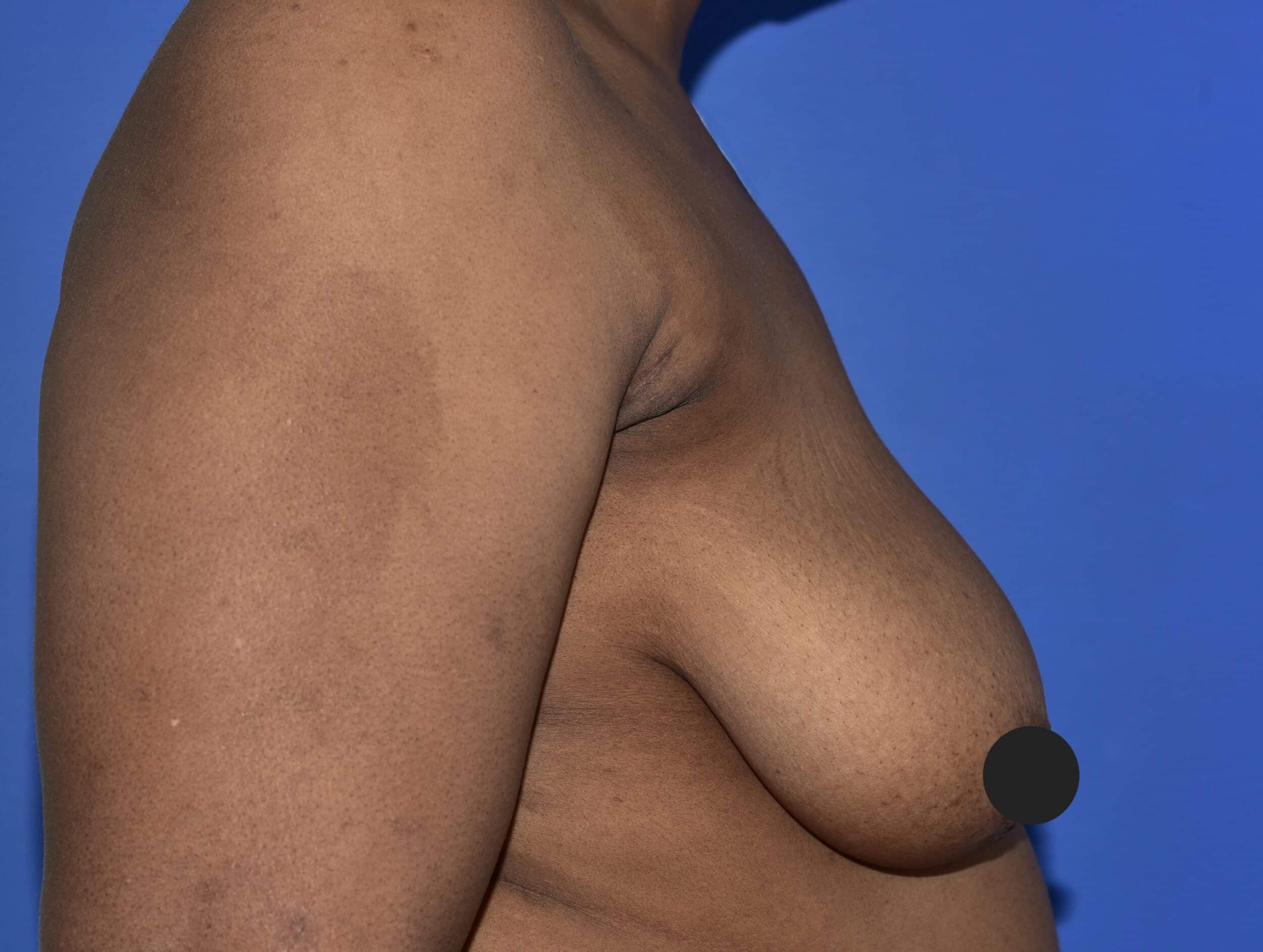 Before Image: Breast Lift and Augmentation - right-side