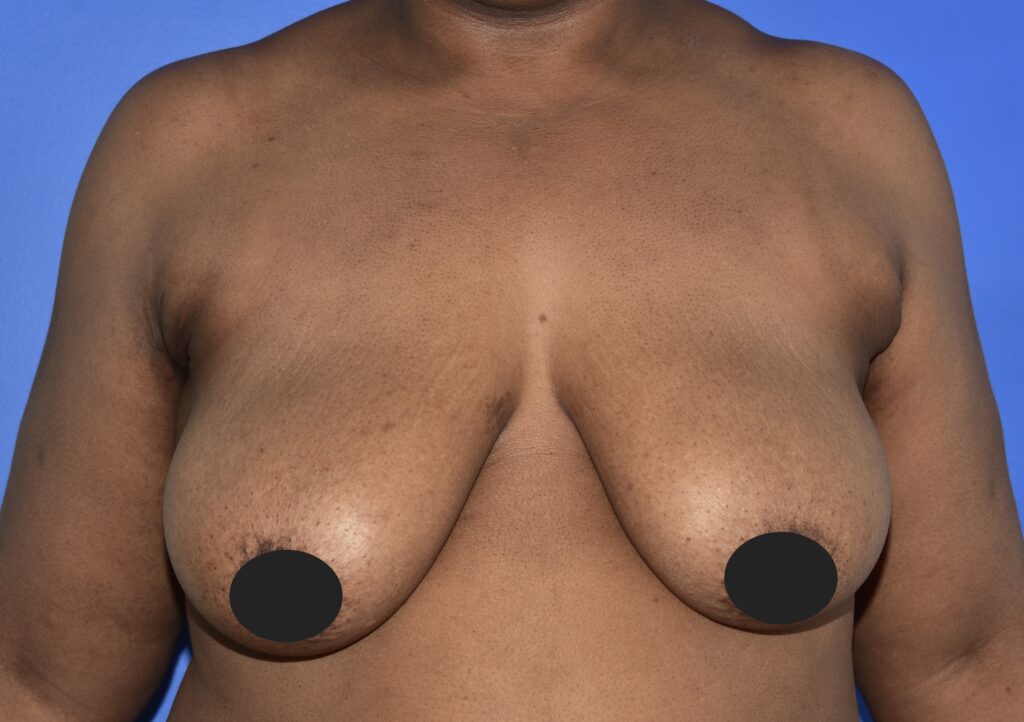 Before Image: Breast Lift and Augmentation - front