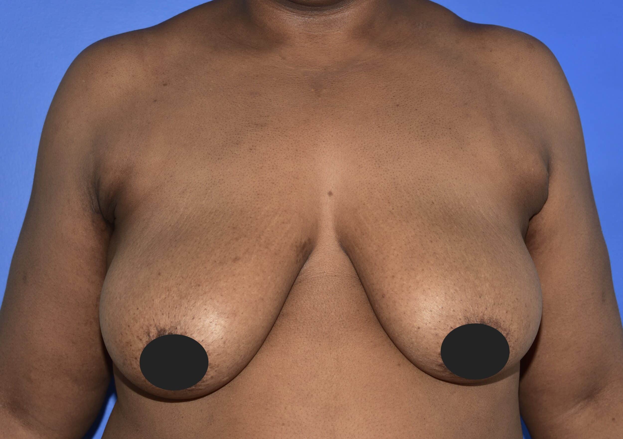 Before Image: Breast Lift and Augmentation - front