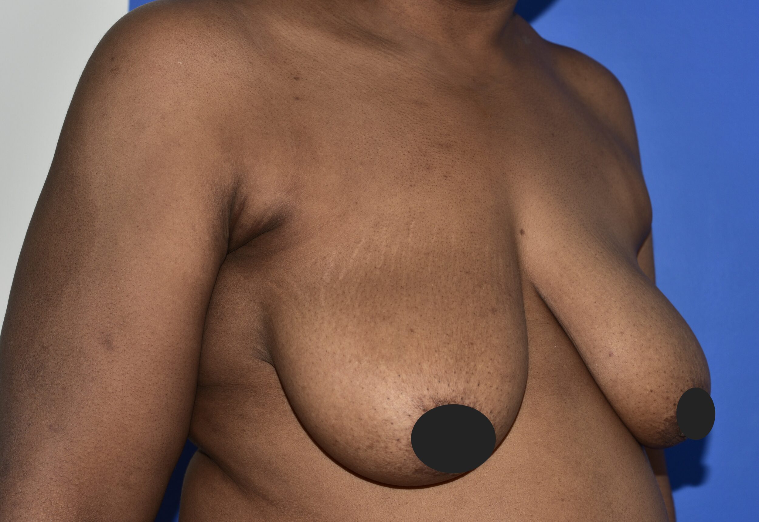 Before Image: Breast Lift and Augmentation - right-front-oblique