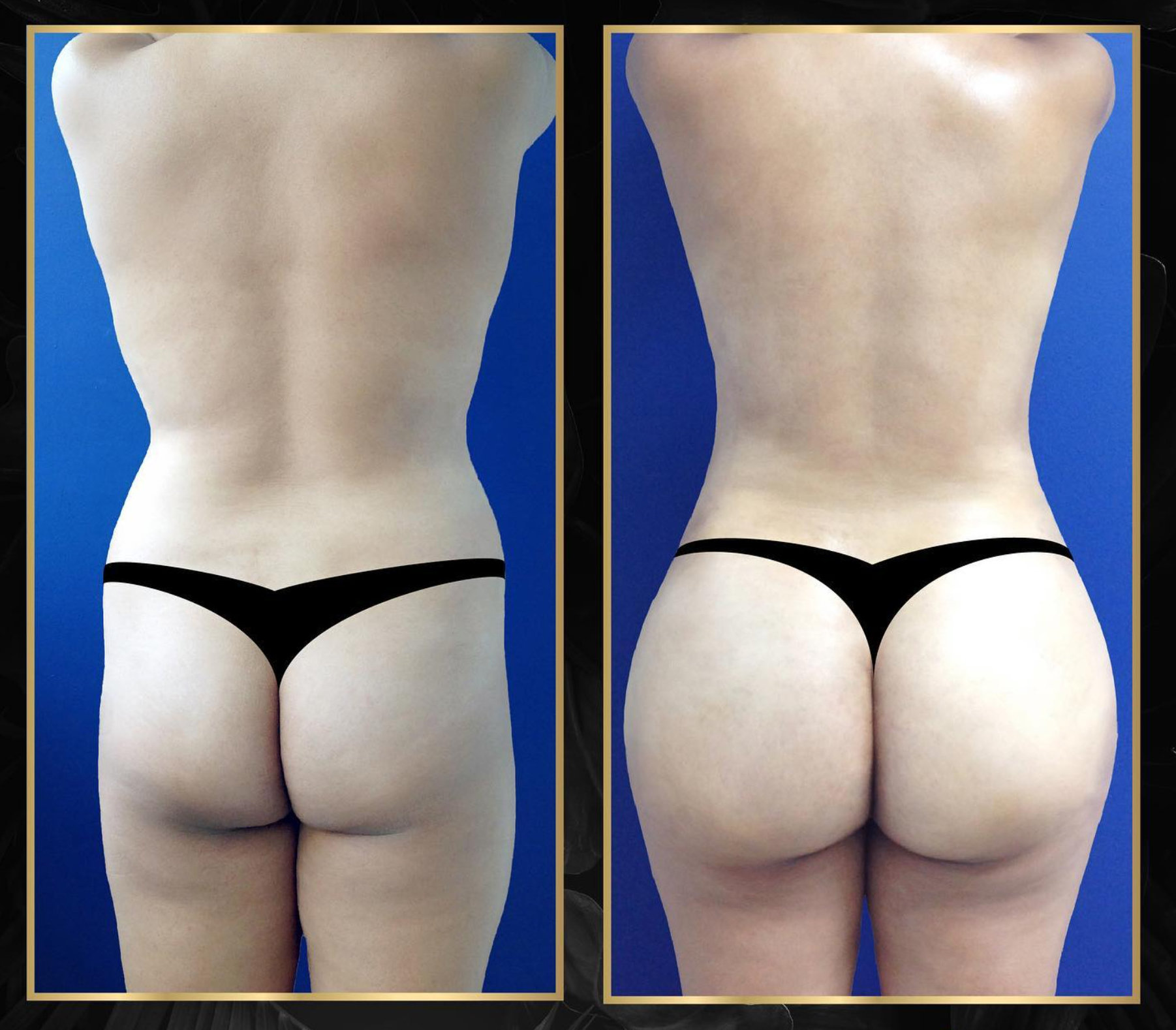 Before and After Image: Brazilian Butt Lift - back