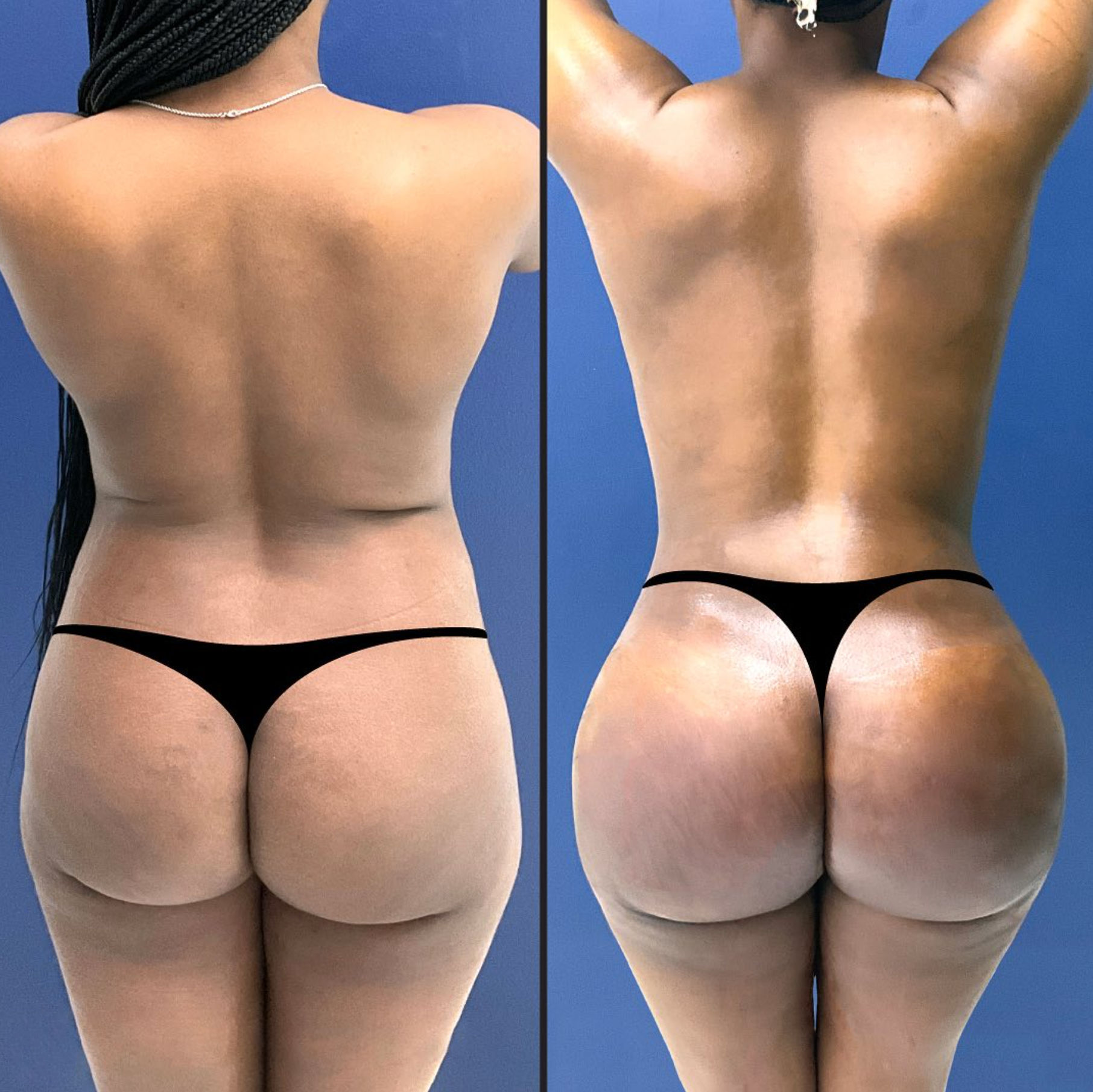 Before and After Image: Brazilian Butt Lift - back