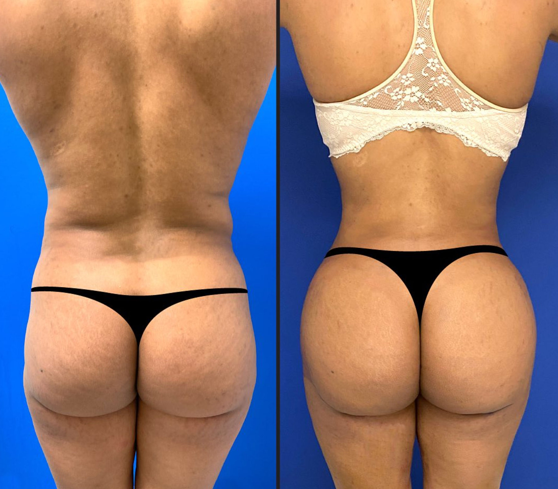 Before and After Image: Brazilian Butt Lift - back
