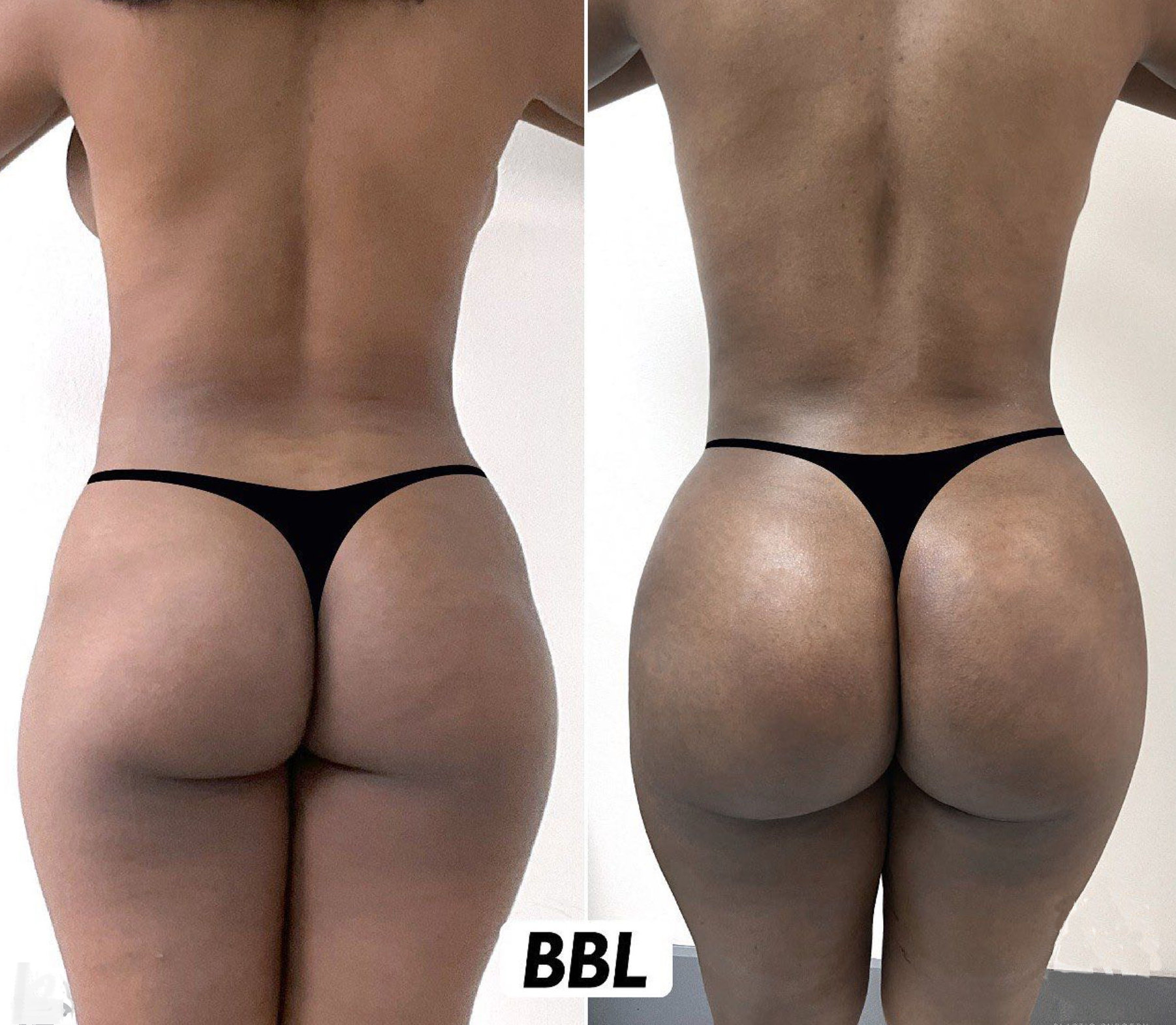 Before and After Image: Brazilian Butt Lift - back