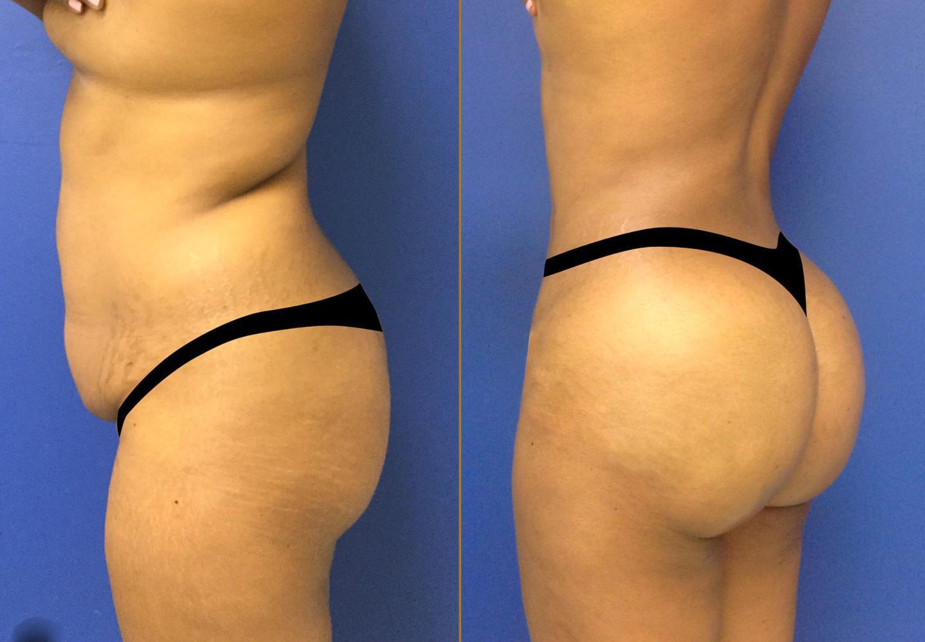 Before and After Image: Brazilian Butt Lift - left-back-oblique