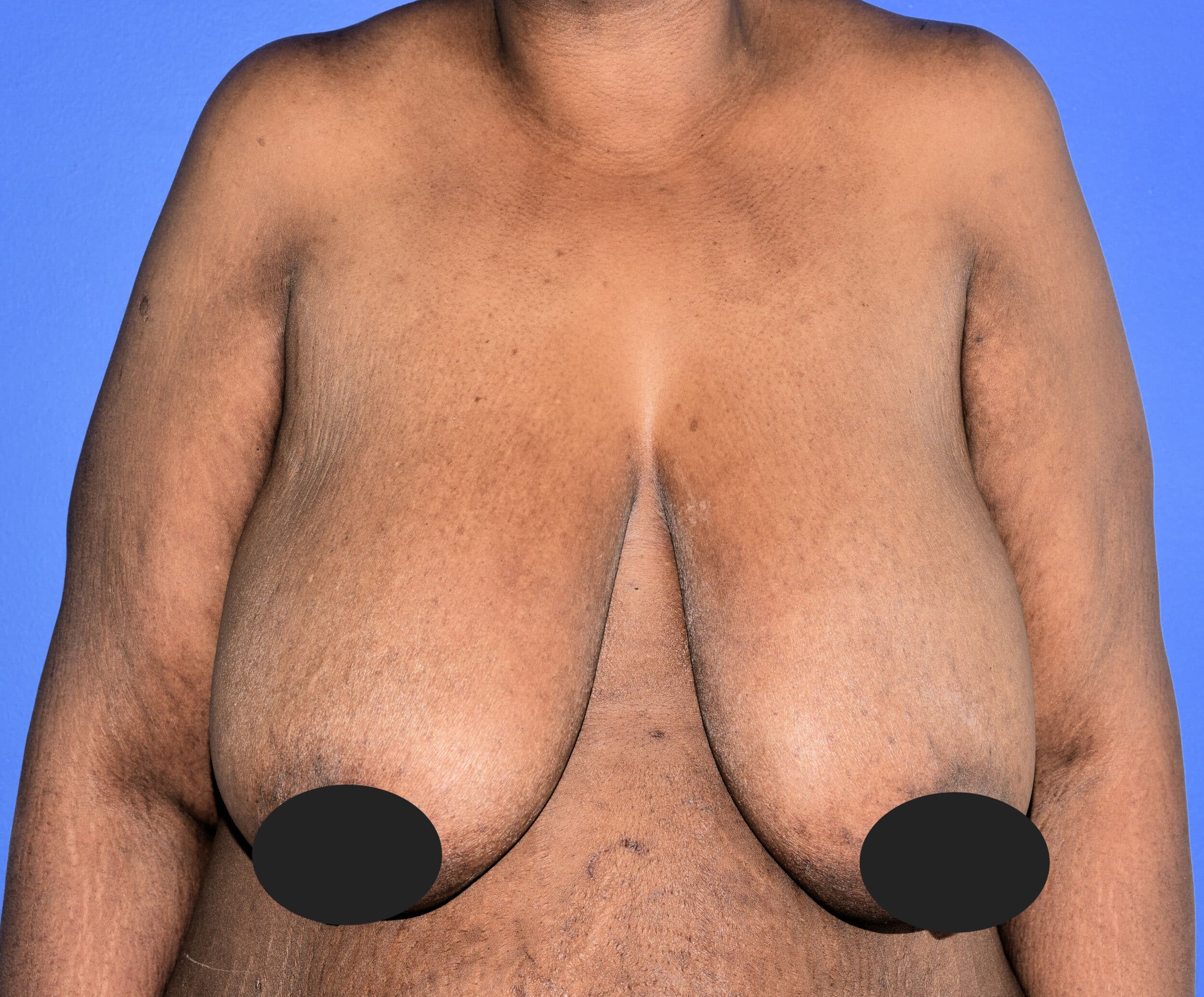 Before Image: Breast Reduction and Lift - front