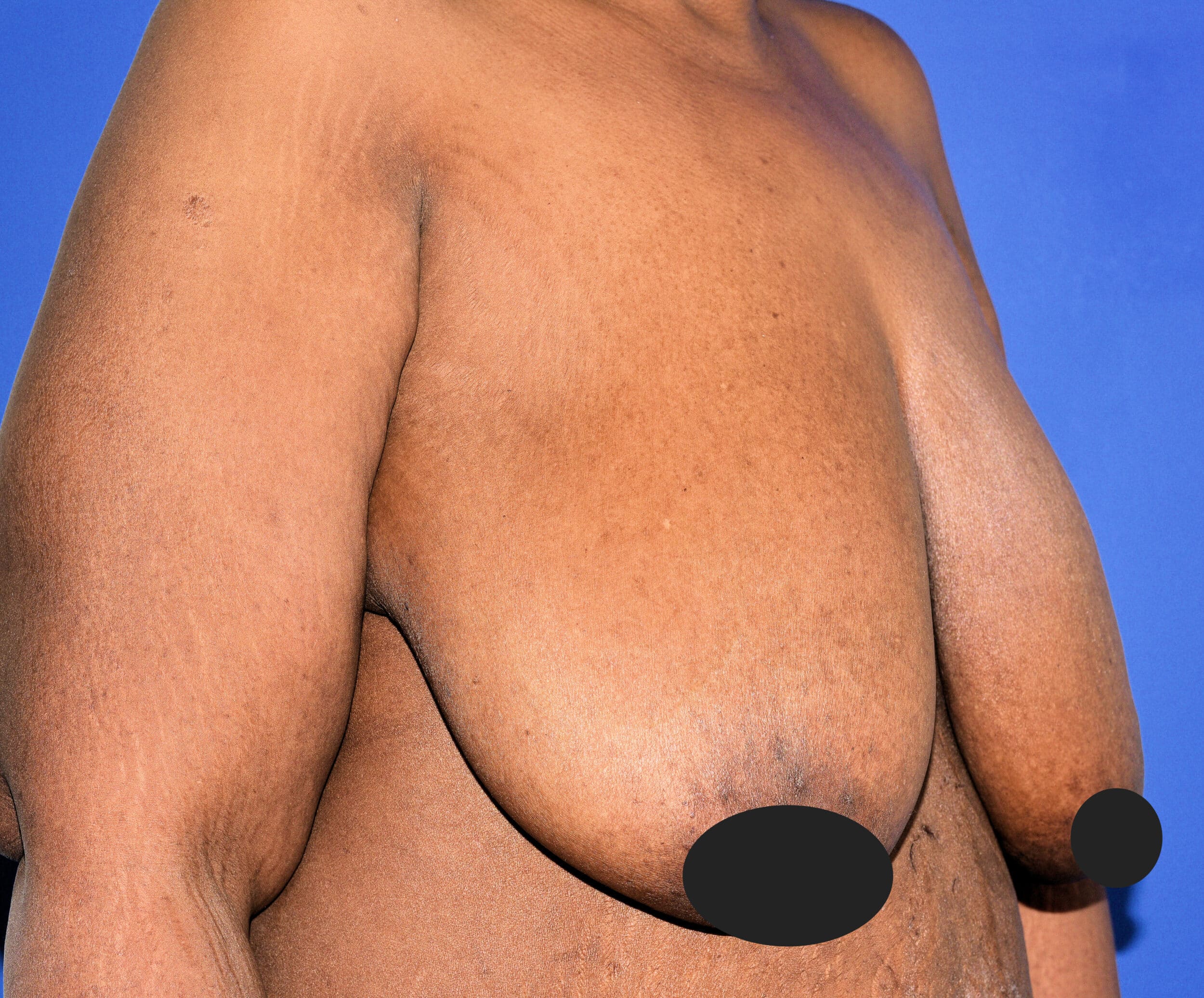 Before Image: Breast Reduction and Lift - right-front-oblique