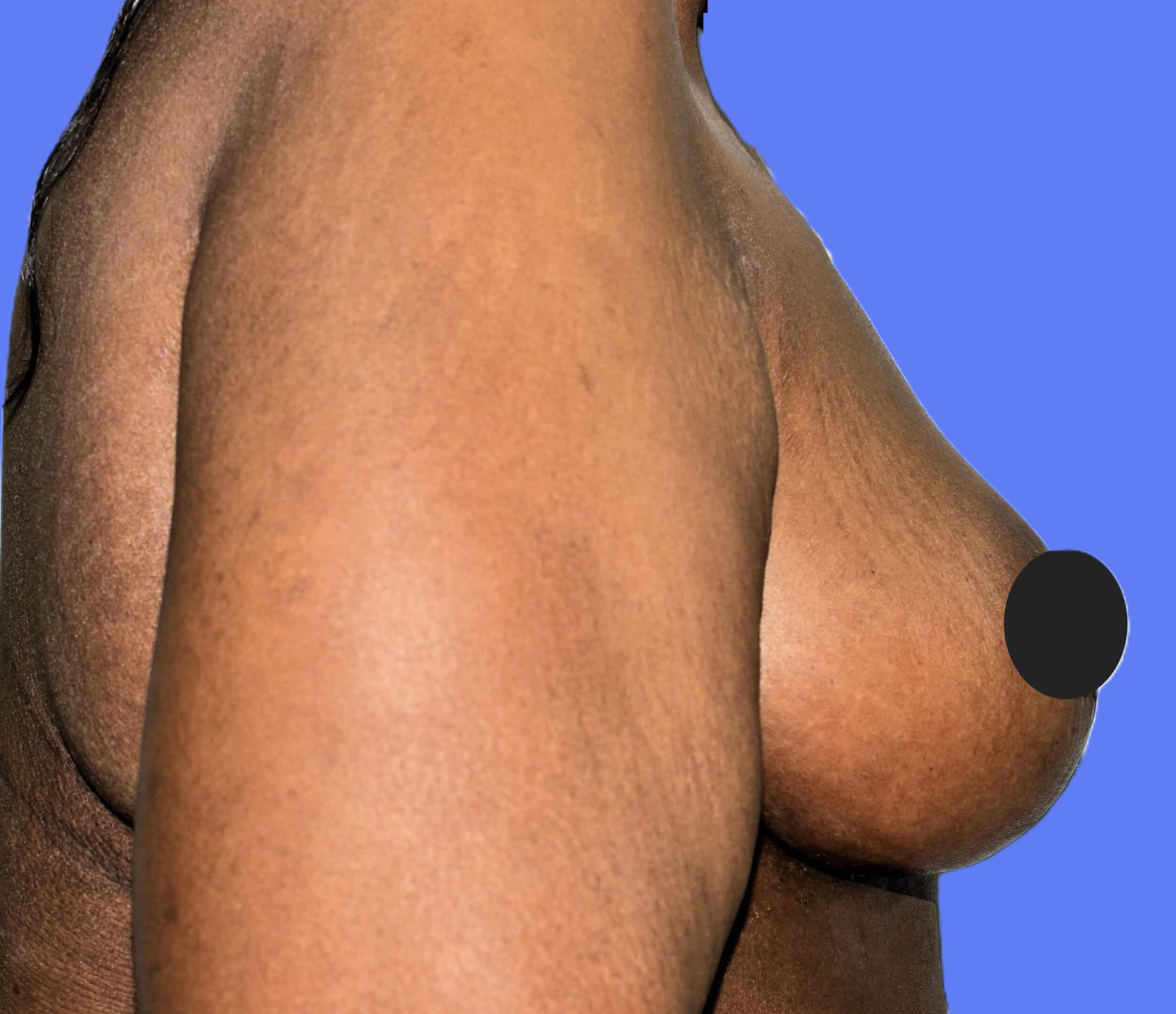 After Image: Breast Reduction and Lift - right-side