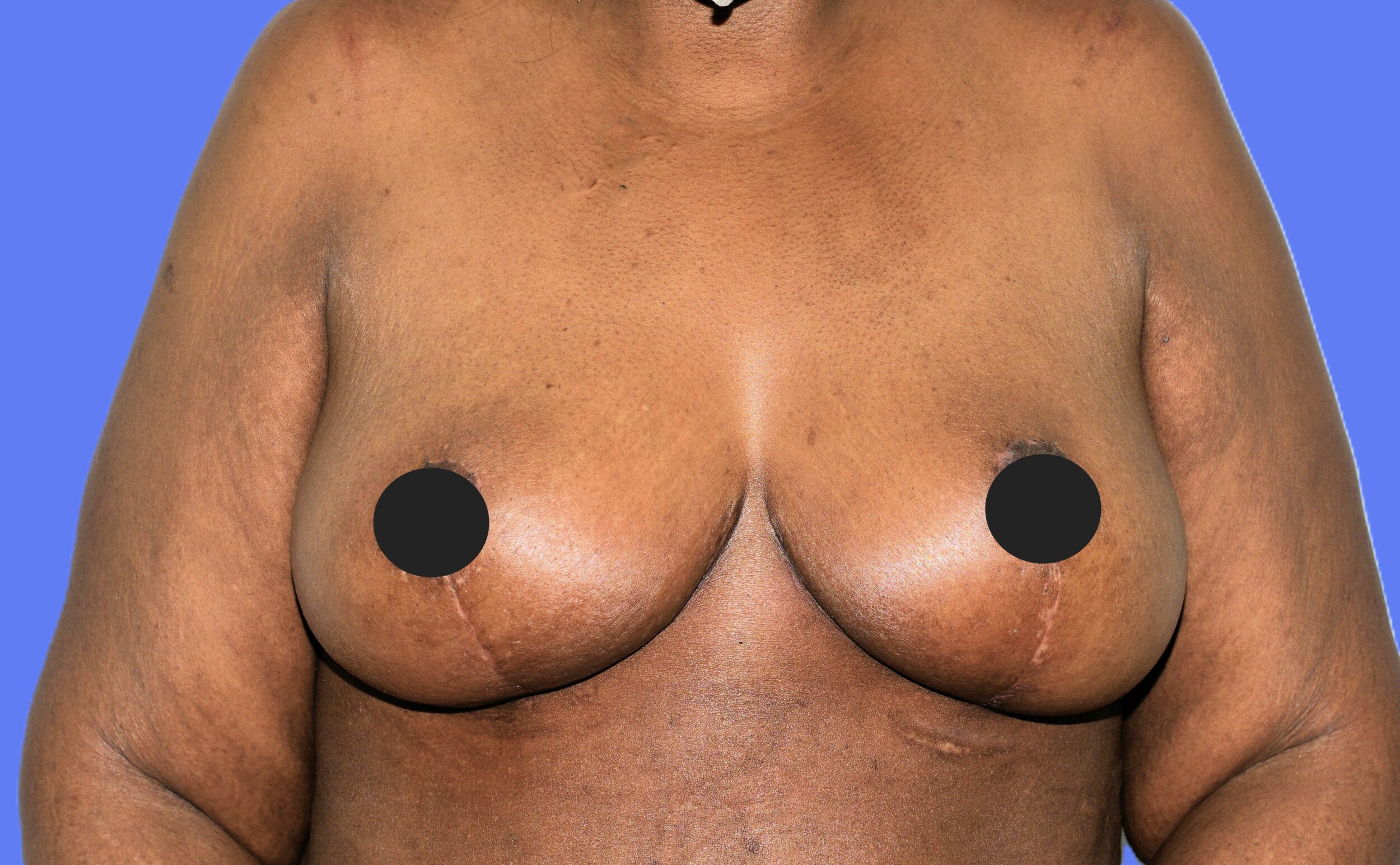 After Image: Breast Reduction and Lift - front