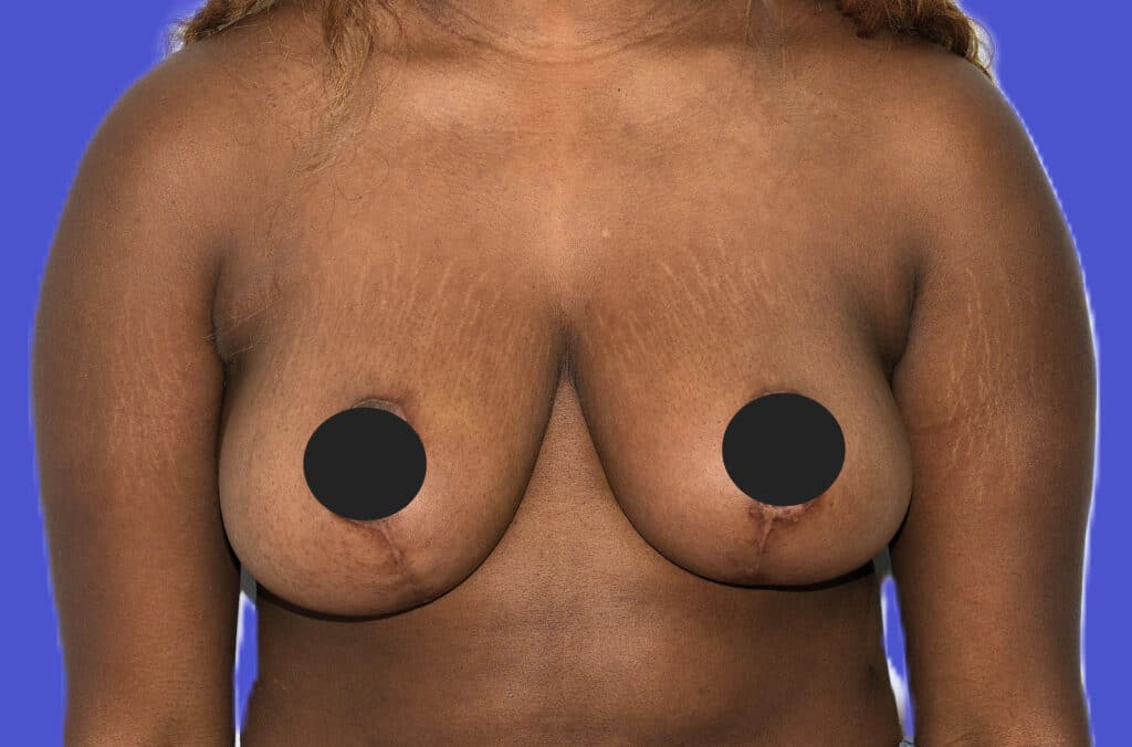 After Image: Breast Reduction and Lift - front