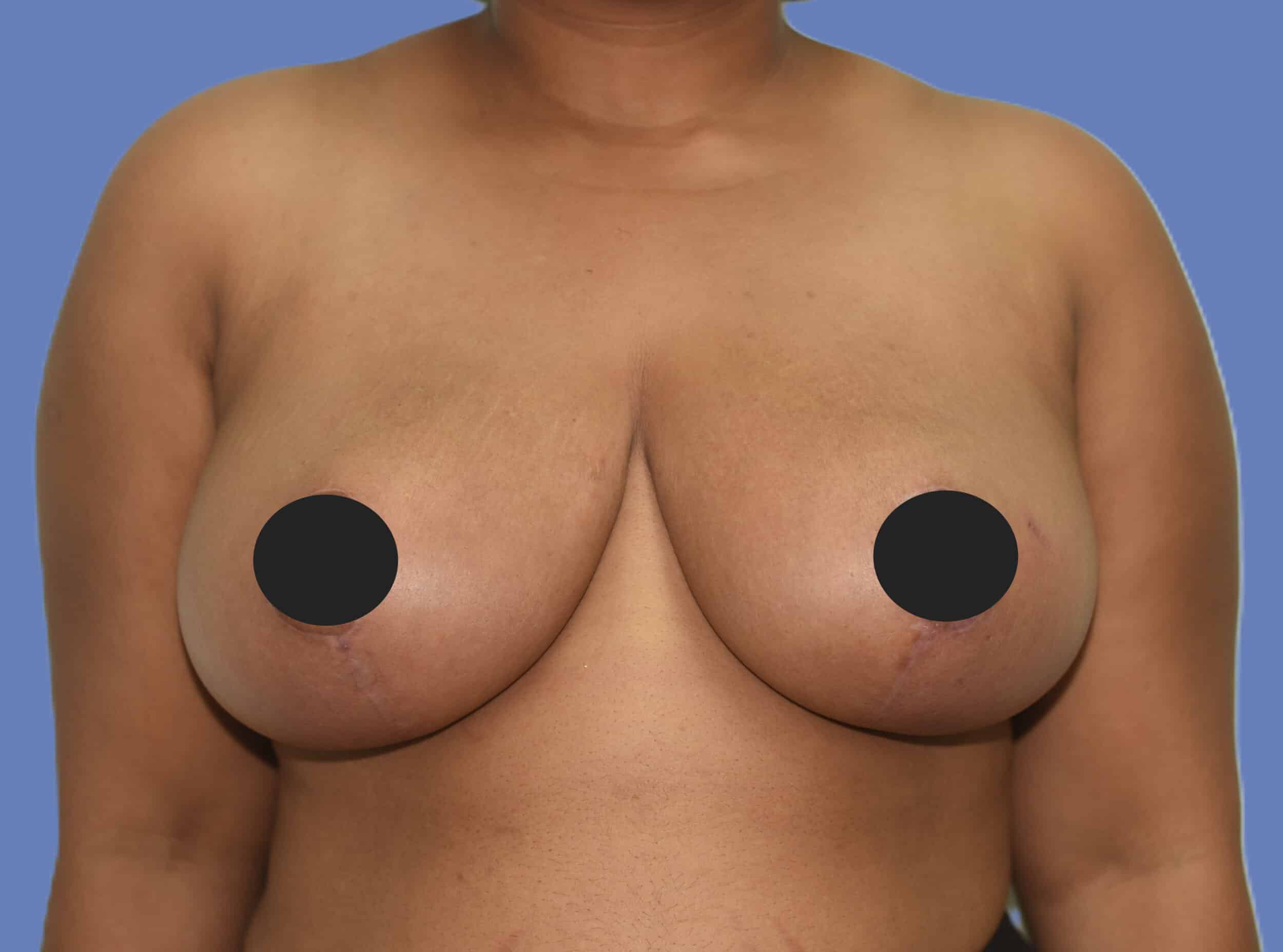 After Image: Breast Reduction and Lift - front