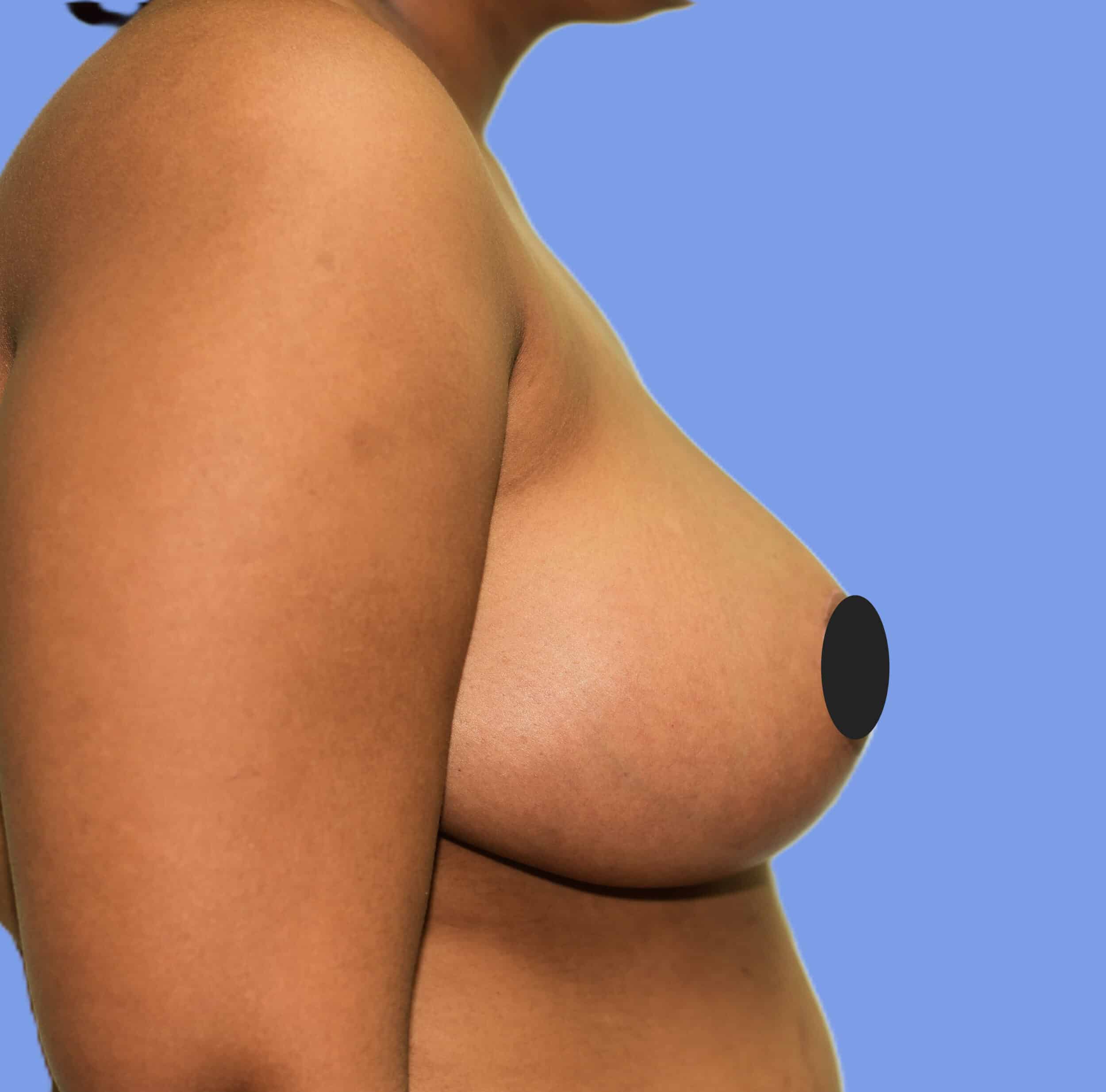 After Image: Breast Reduction and Lift - right-side
