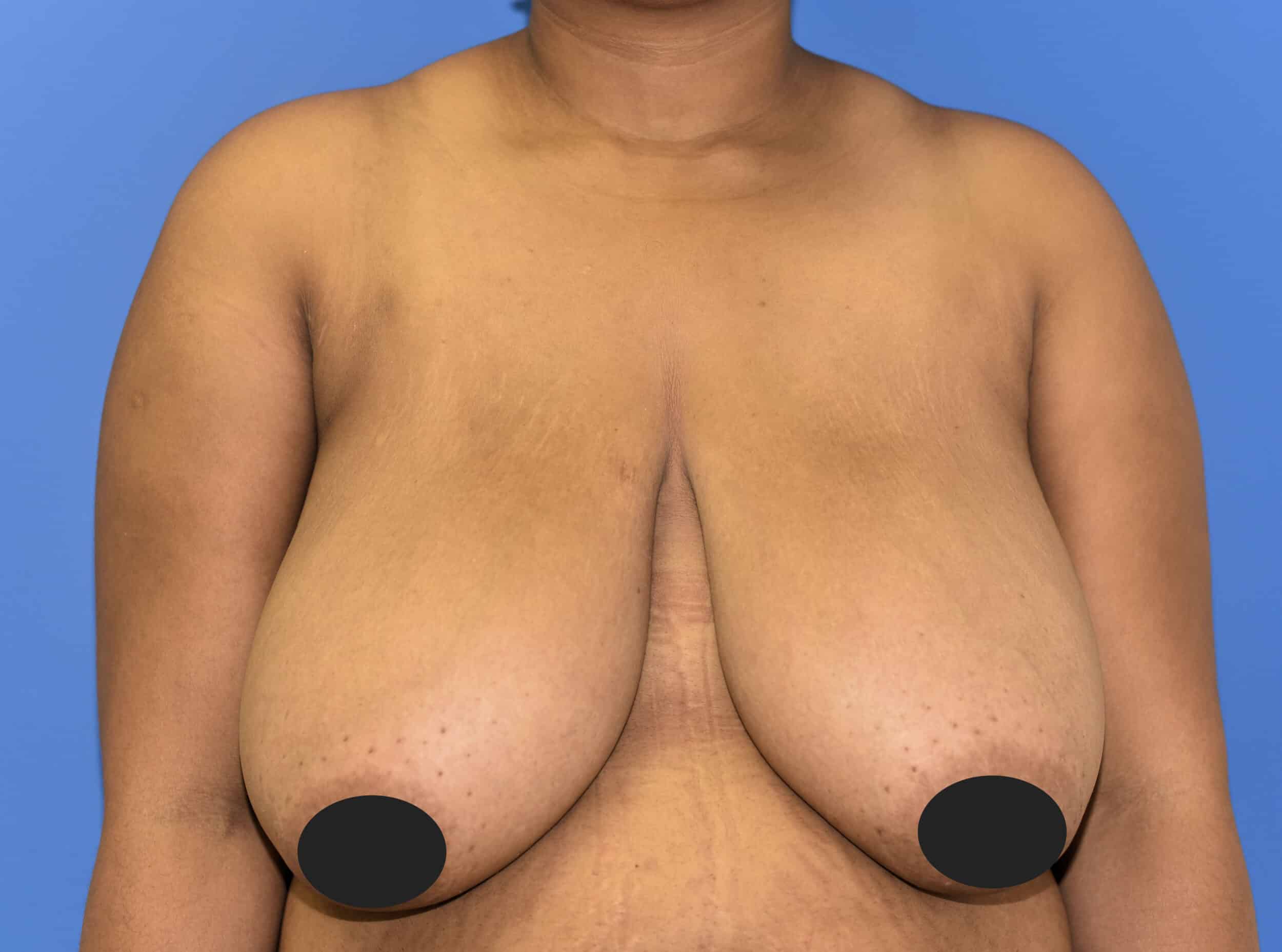 Before Image: Breast Reduction and Lift - front