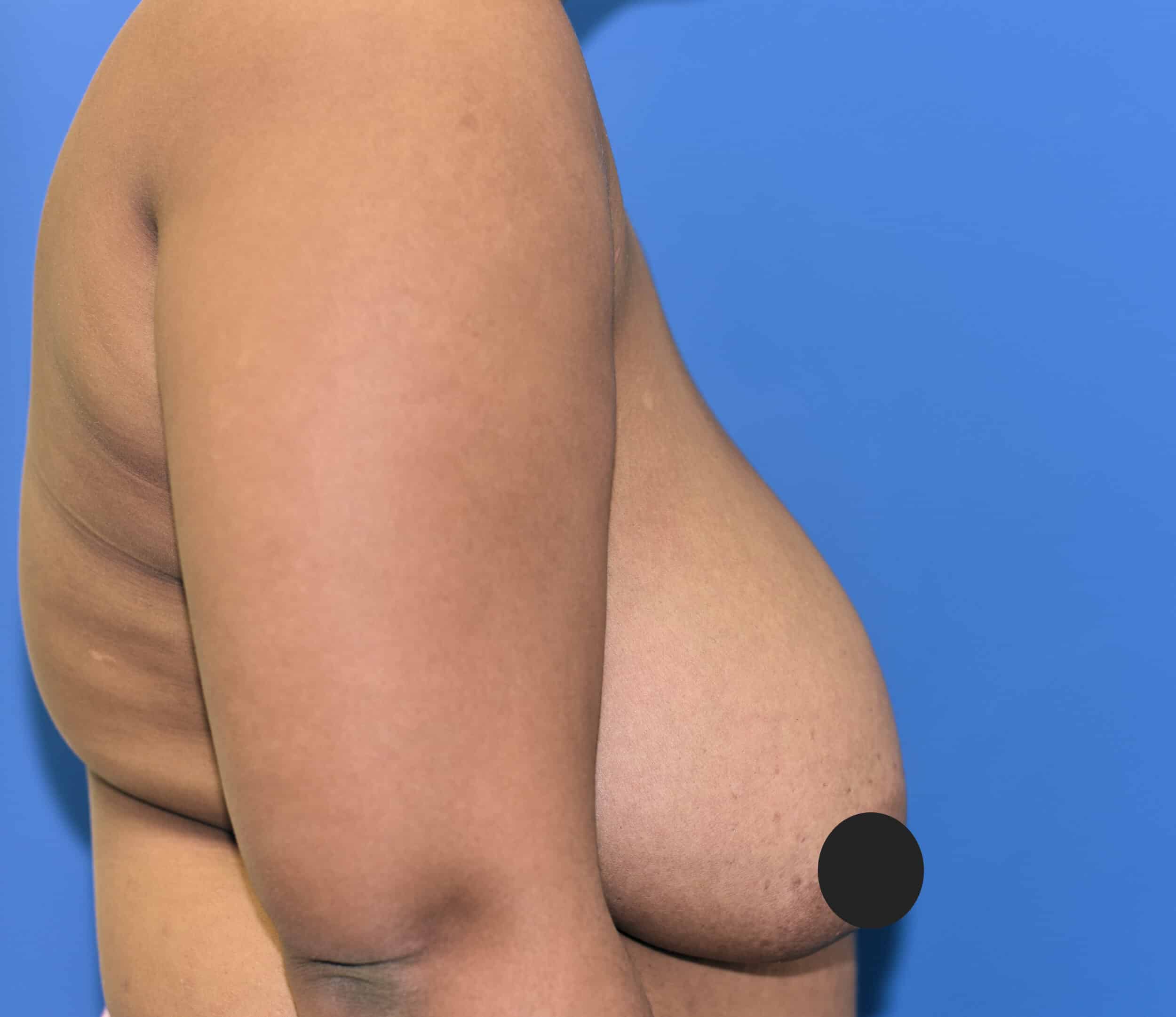 Before Image: Breast Reduction and Lift - right-side