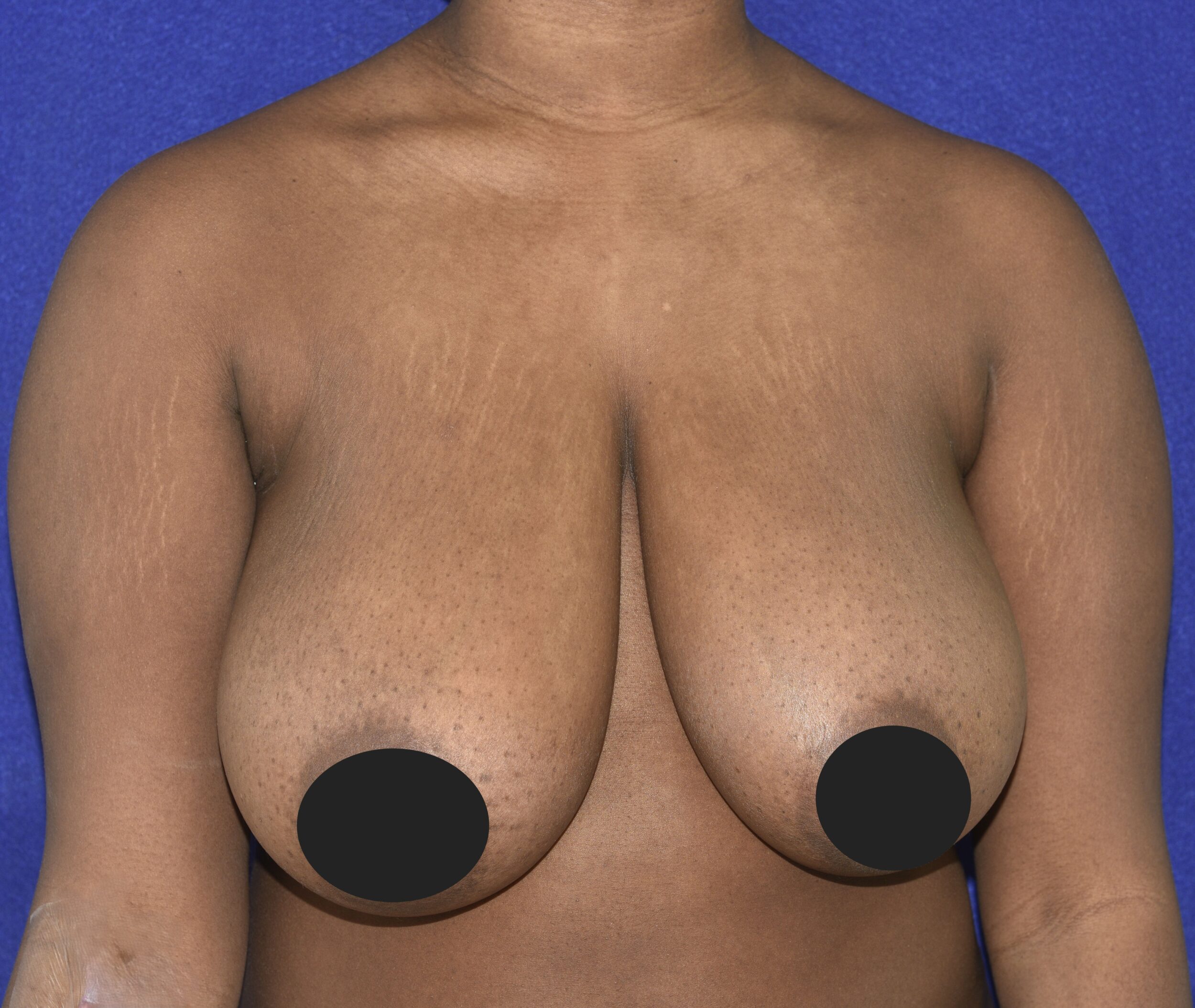 Before Image: Breast Reduction and Lift - front