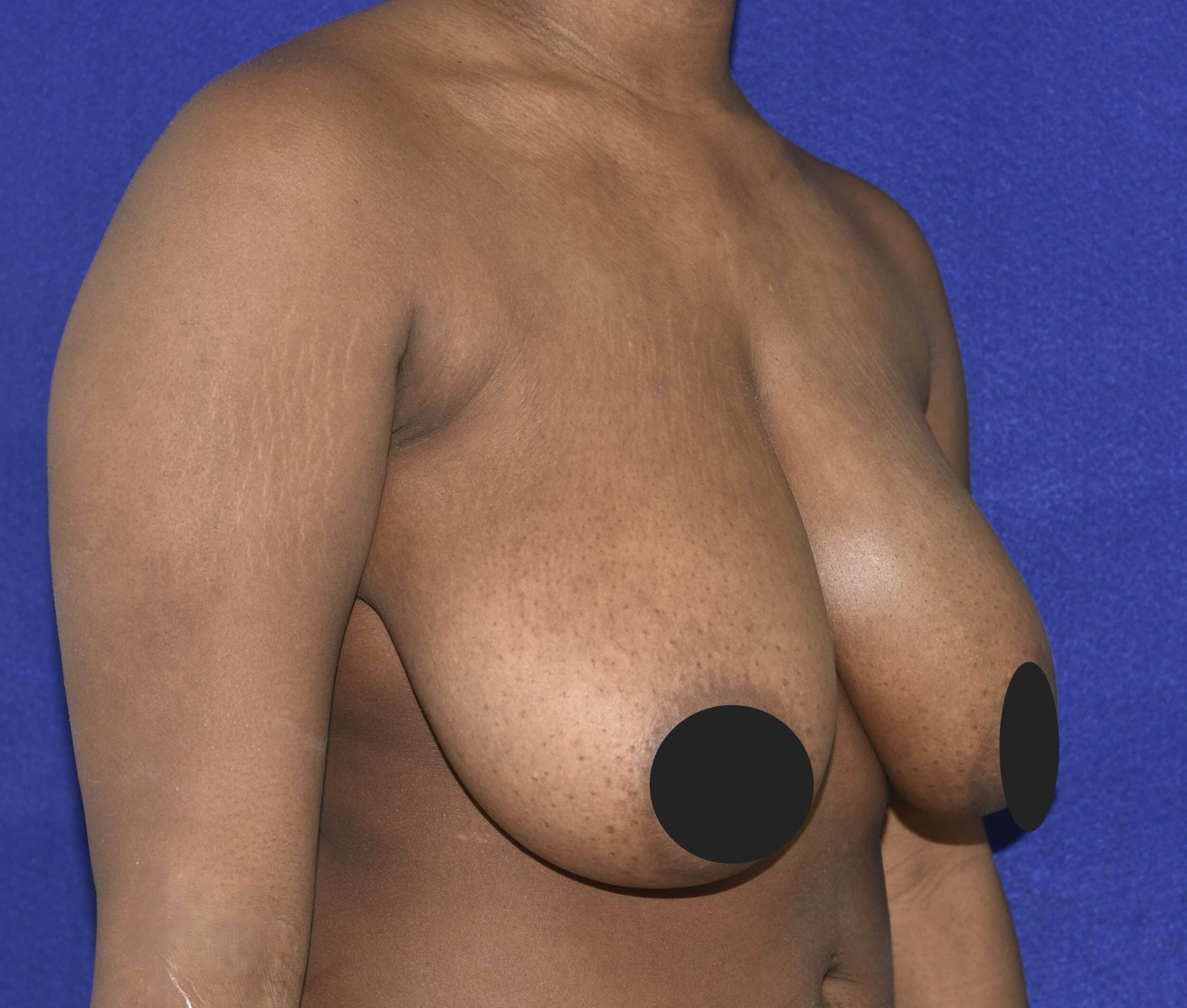 Before Image: Breast Reduction and Lift - right-front-oblique