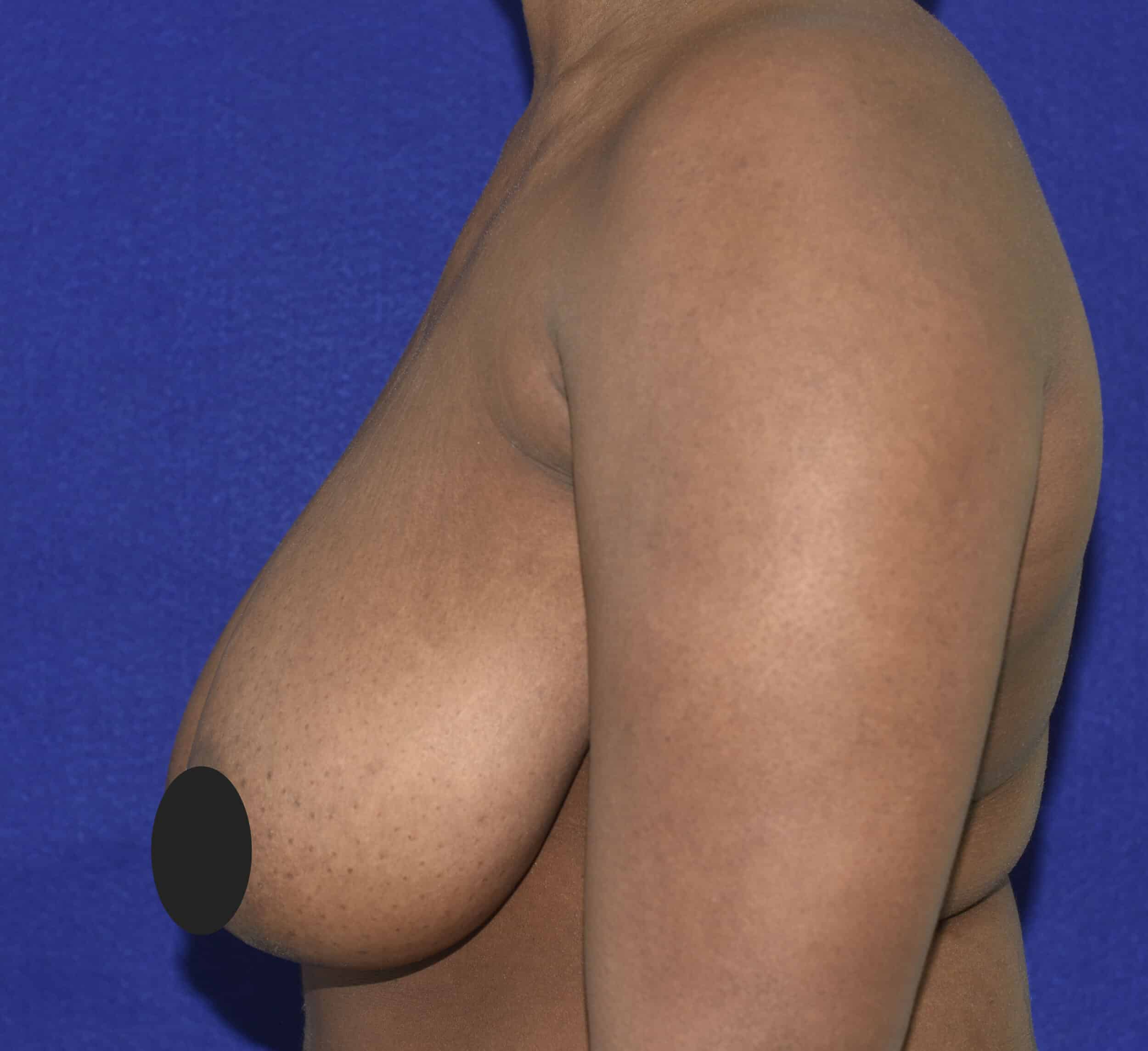 Before Image: Breast Reduction and Lift - left-side