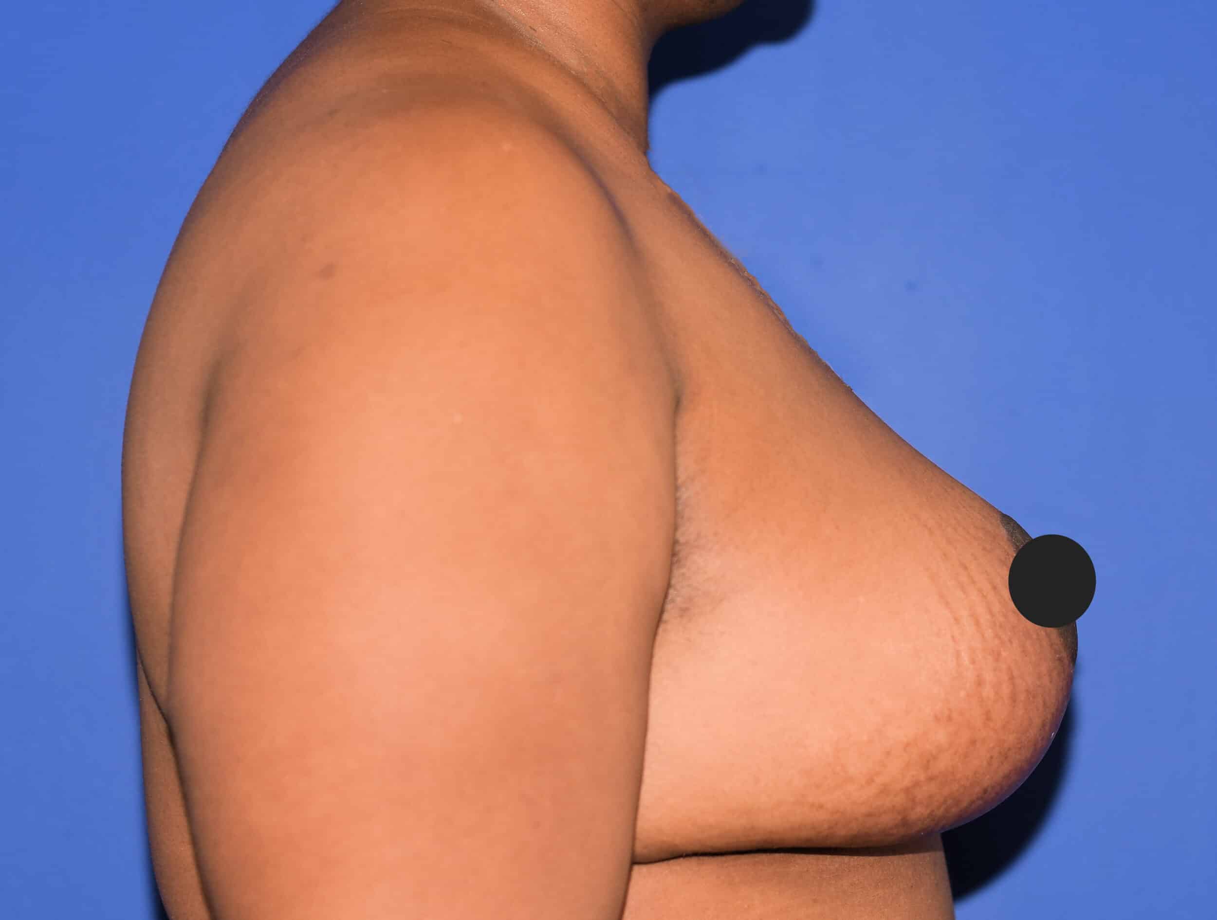 After Image: Breast Lift - right-side