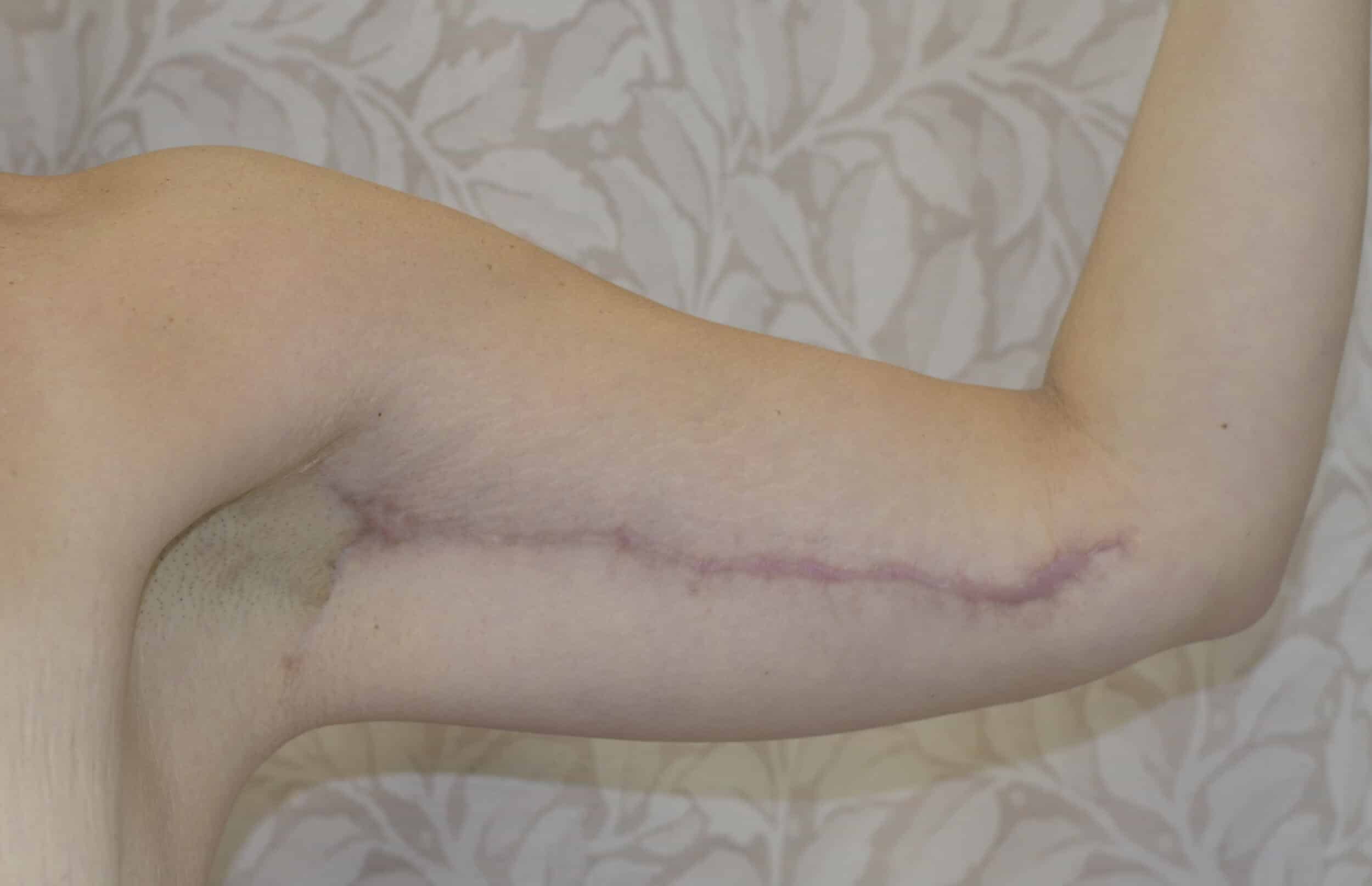 After Image: Brachioplasty (Arm Lift) - left-side