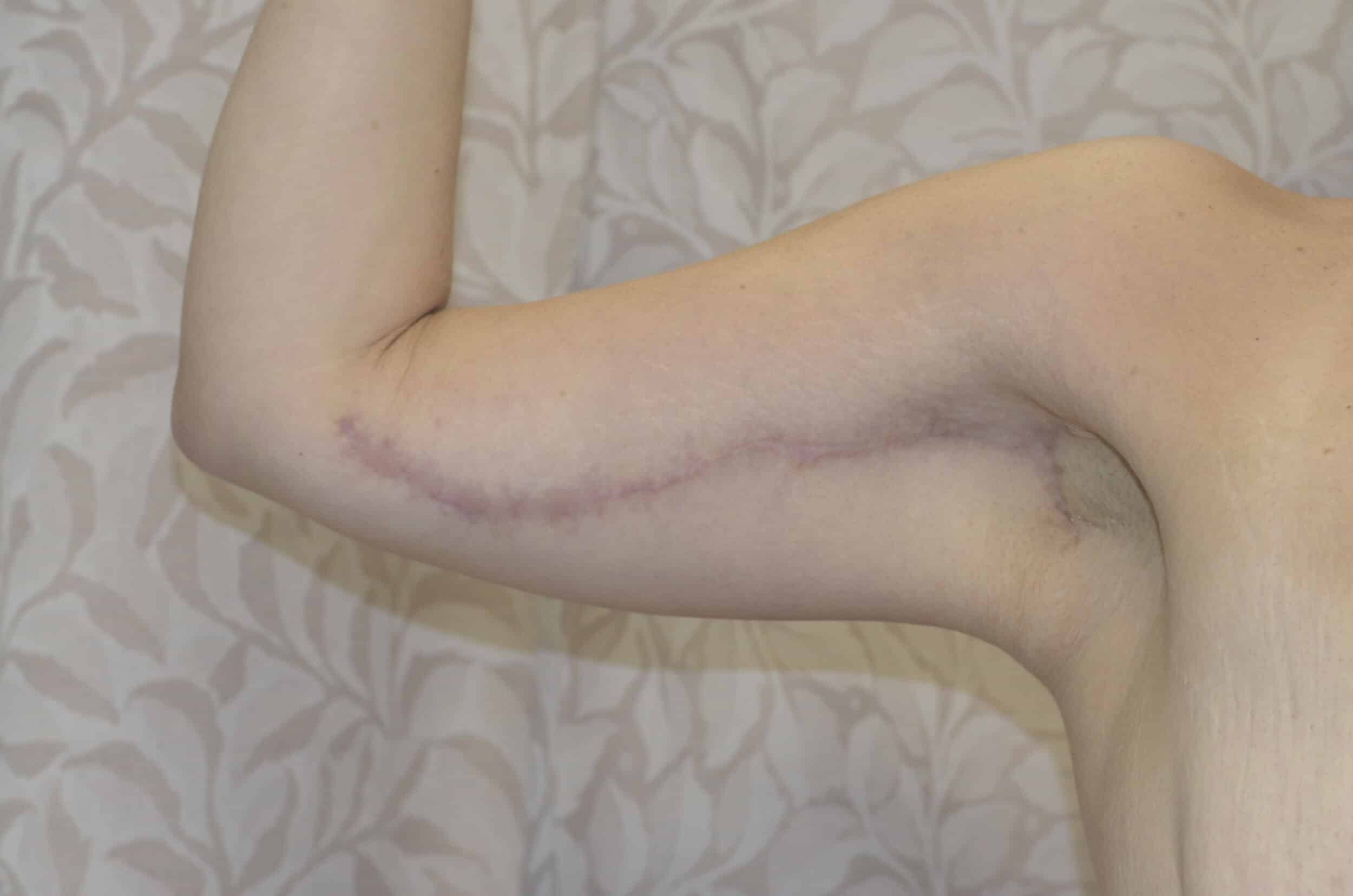 After Image: Brachioplasty (Arm Lift) - right-side