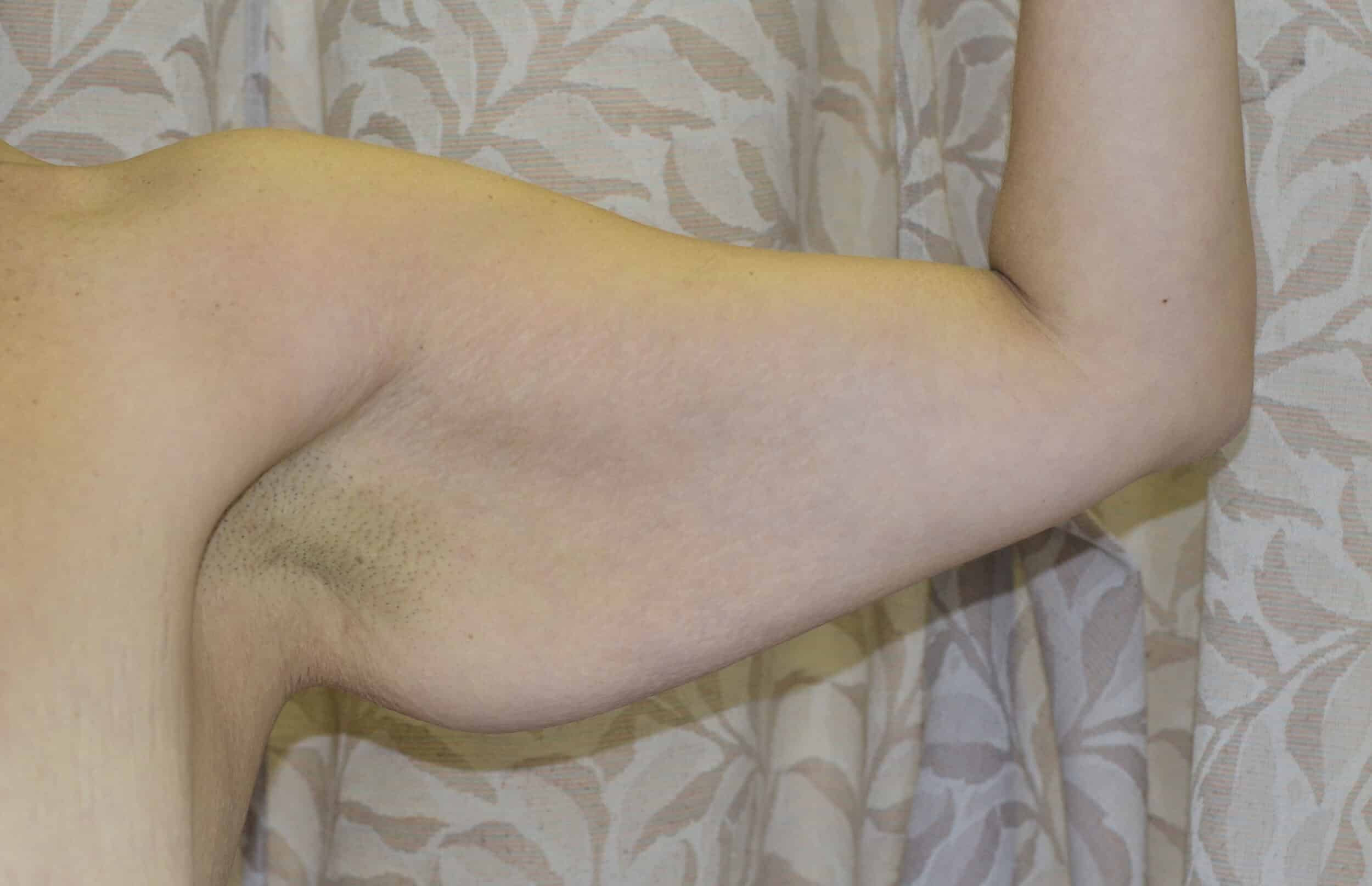 Before Image: Brachioplasty (Arm Lift) - left-side