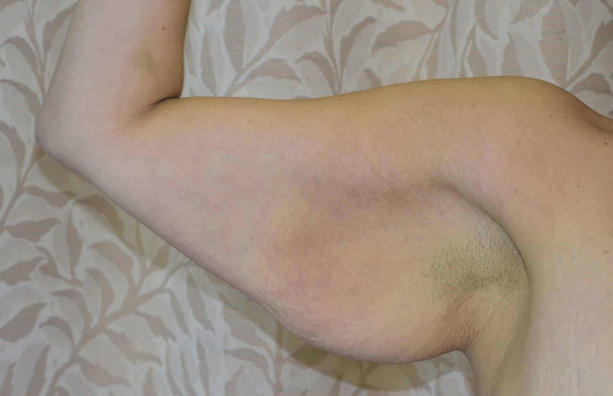 Before Image: Brachioplasty (Arm Lift) - right-side