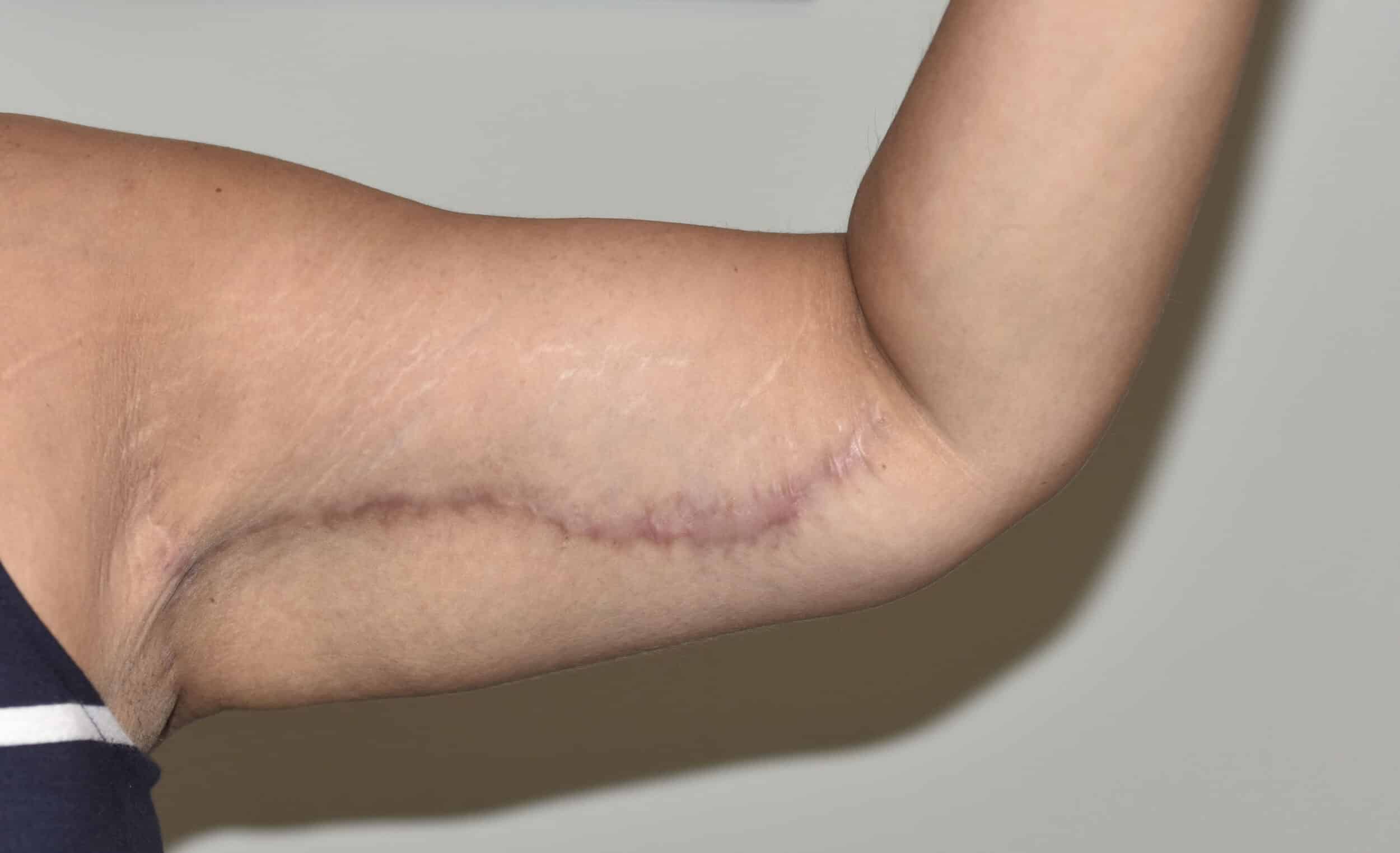 After Image: Brachioplasty (Arm Lift) - left-side