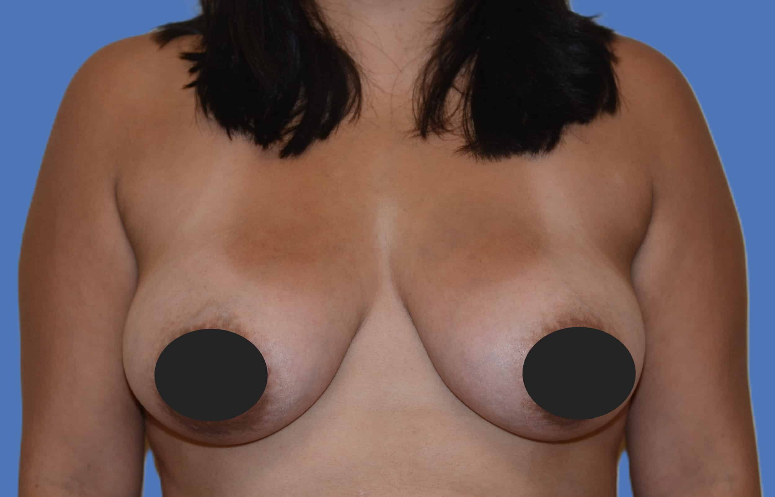 After Image: Breast Fat Transfer - front