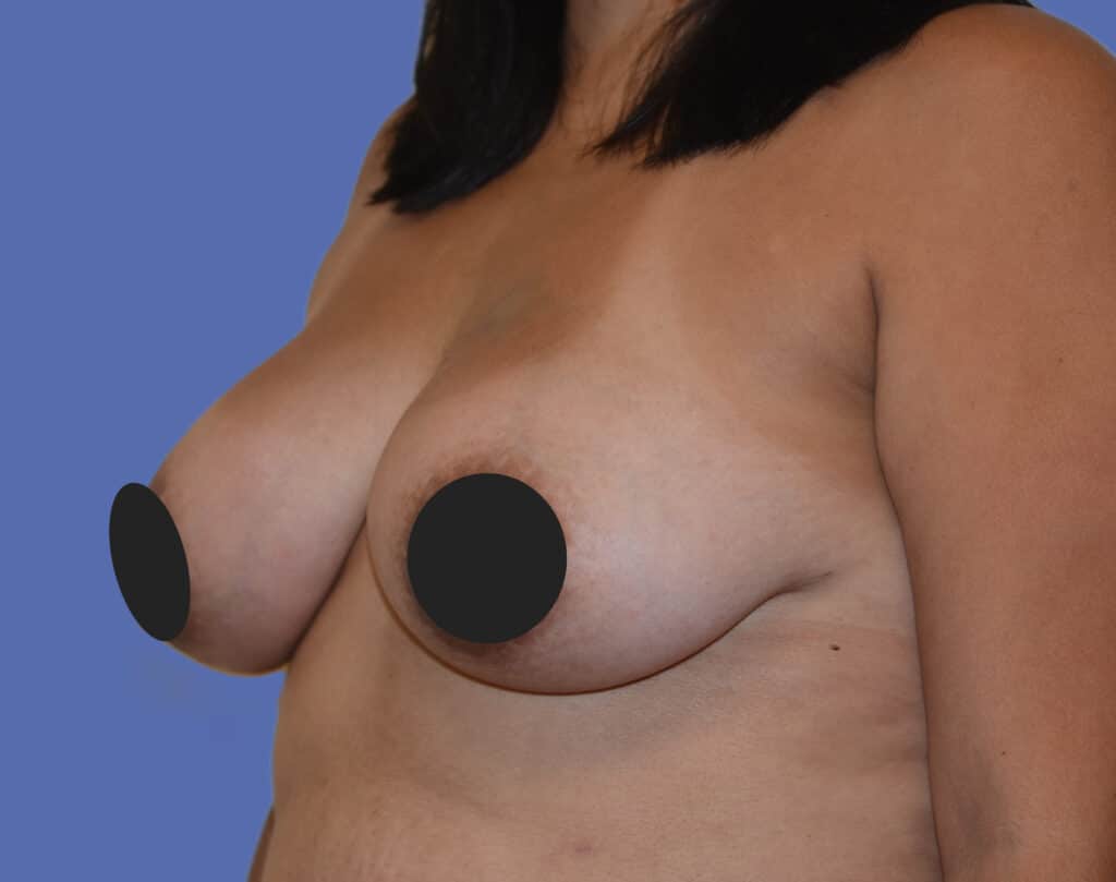 After Image: Breast Fat Transfer - left-front-oblique