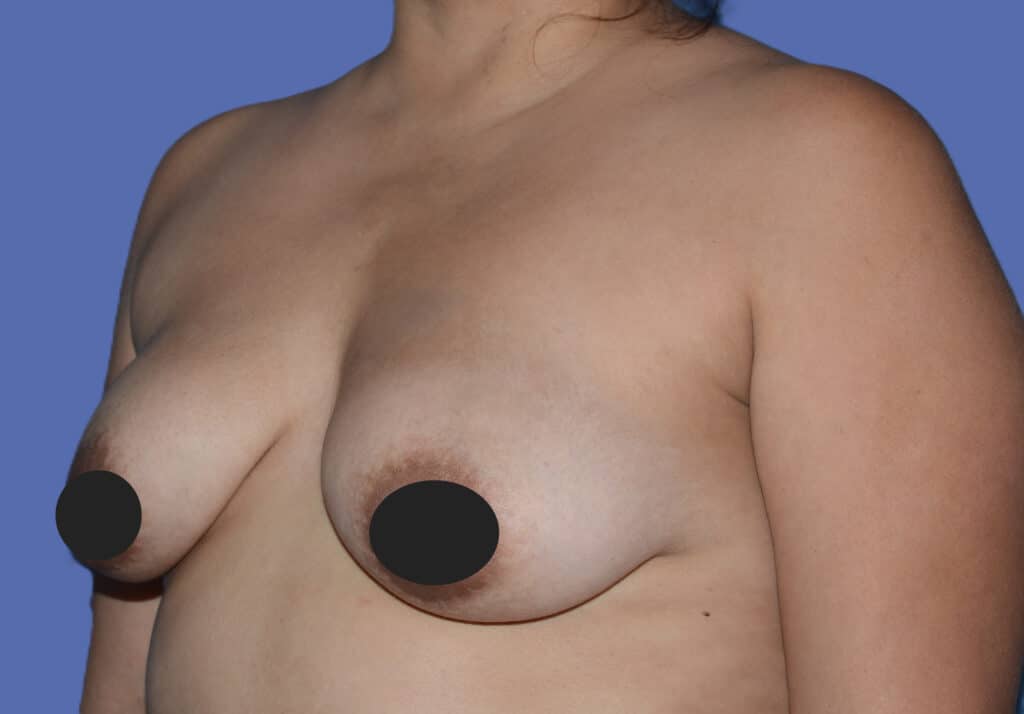 Before Image: Breast Fat Transfer - left-front-oblique