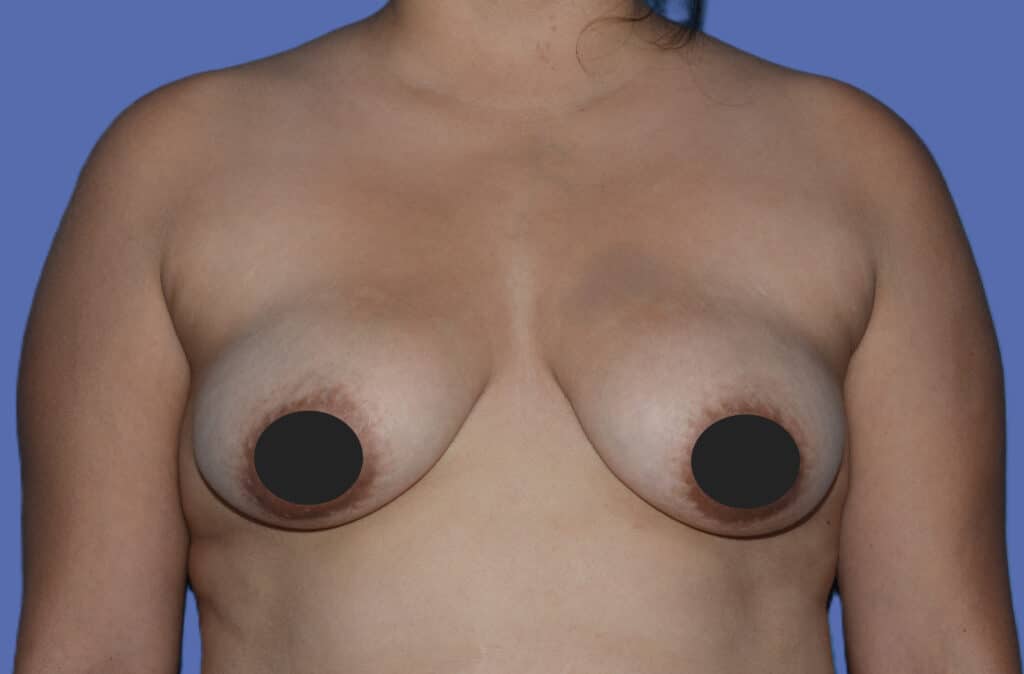 Before Image: Breast Fat Transfer - front