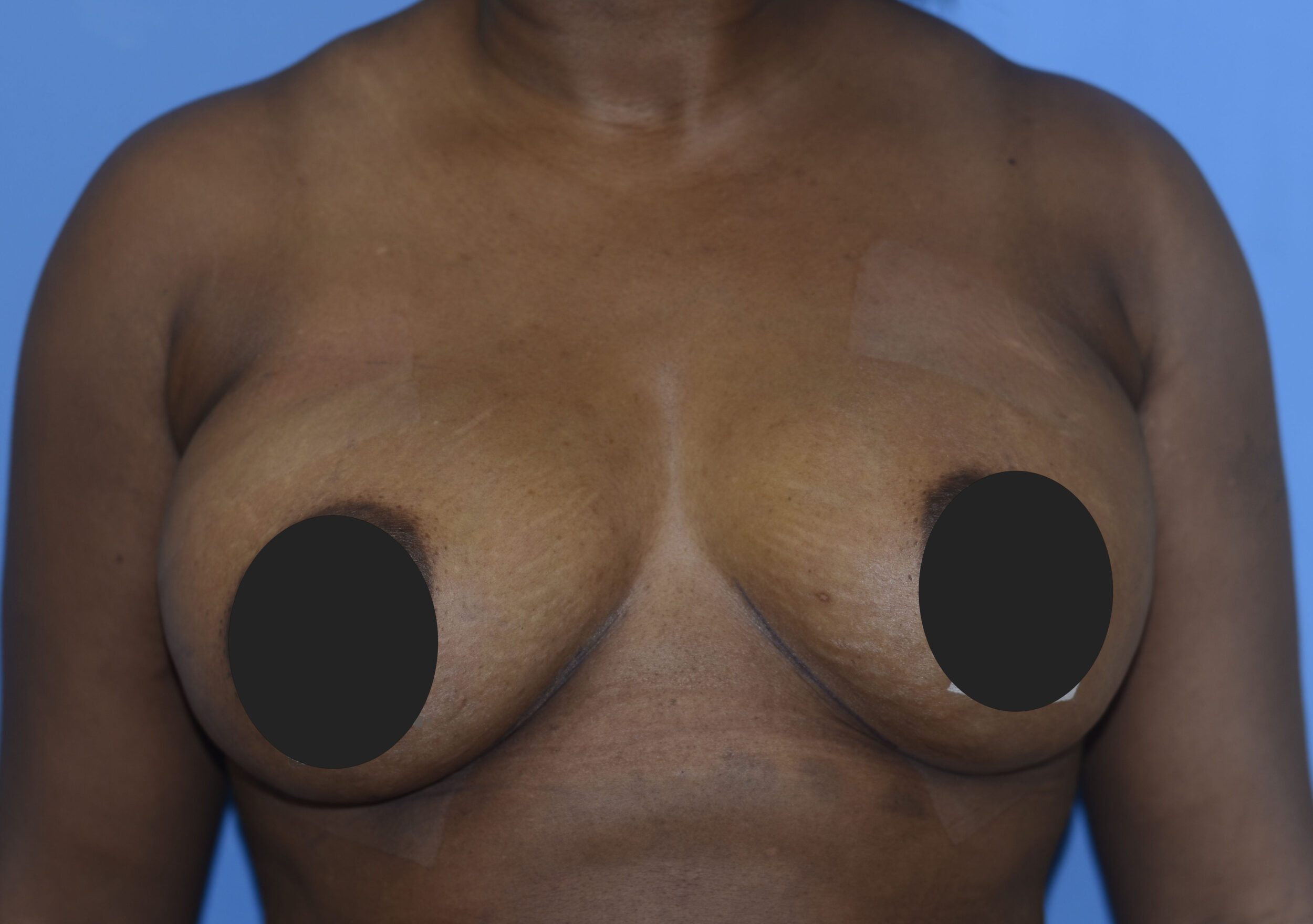 After Image: Breast Fat Transfer - front