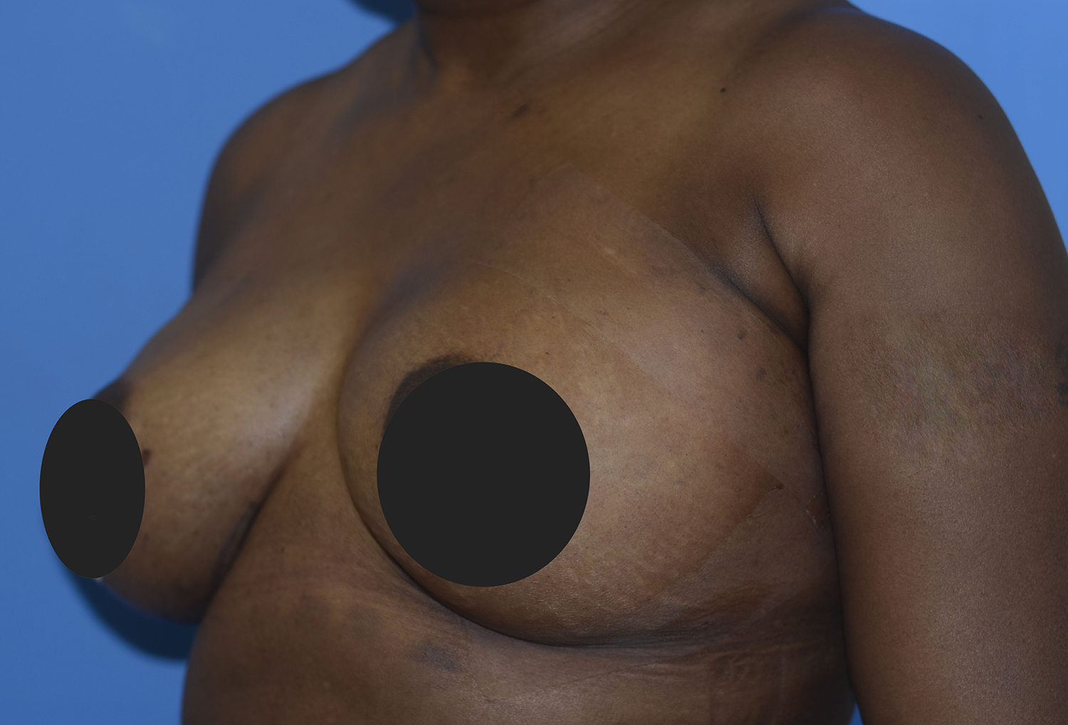 After Image: Breast Fat Transfer - left-front-oblique