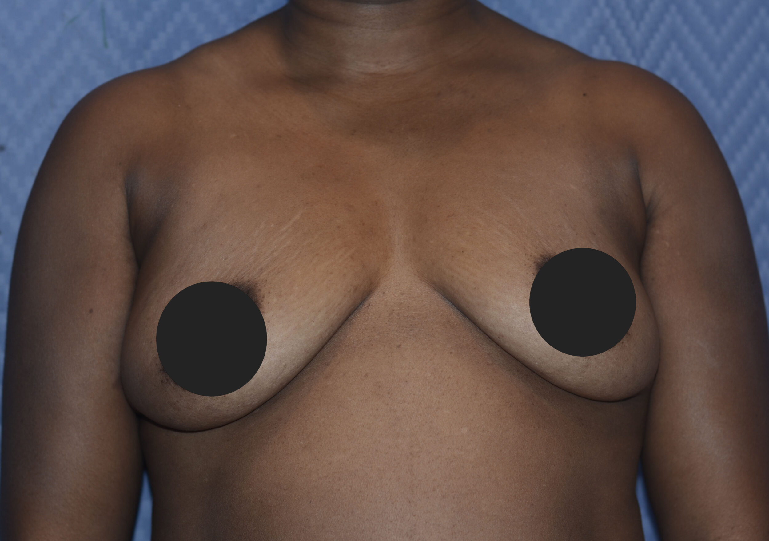 Before Image: Breast Fat Transfer - front