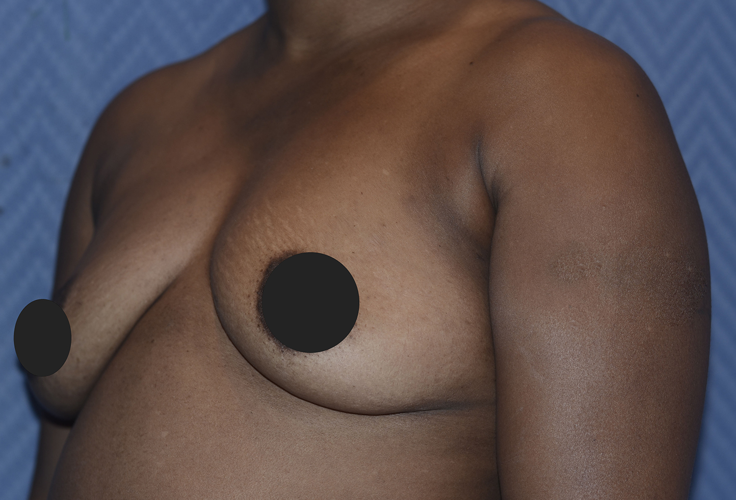 Before Image: Breast Fat Transfer - left-front-oblique