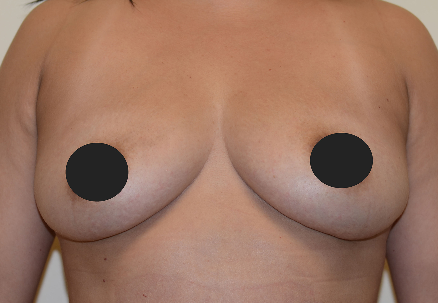 After Image: Breast Fat Transfer - front