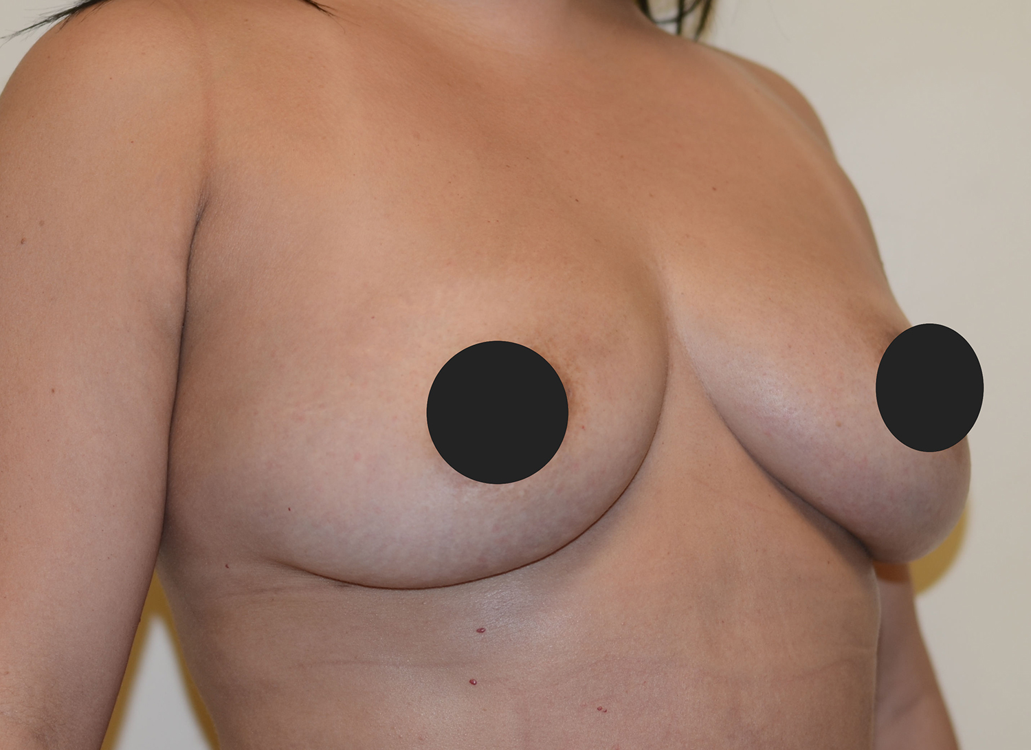 After Image: Breast Fat Transfer - right-front-oblique