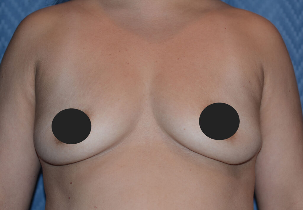 Before Image: Breast Fat Transfer - front